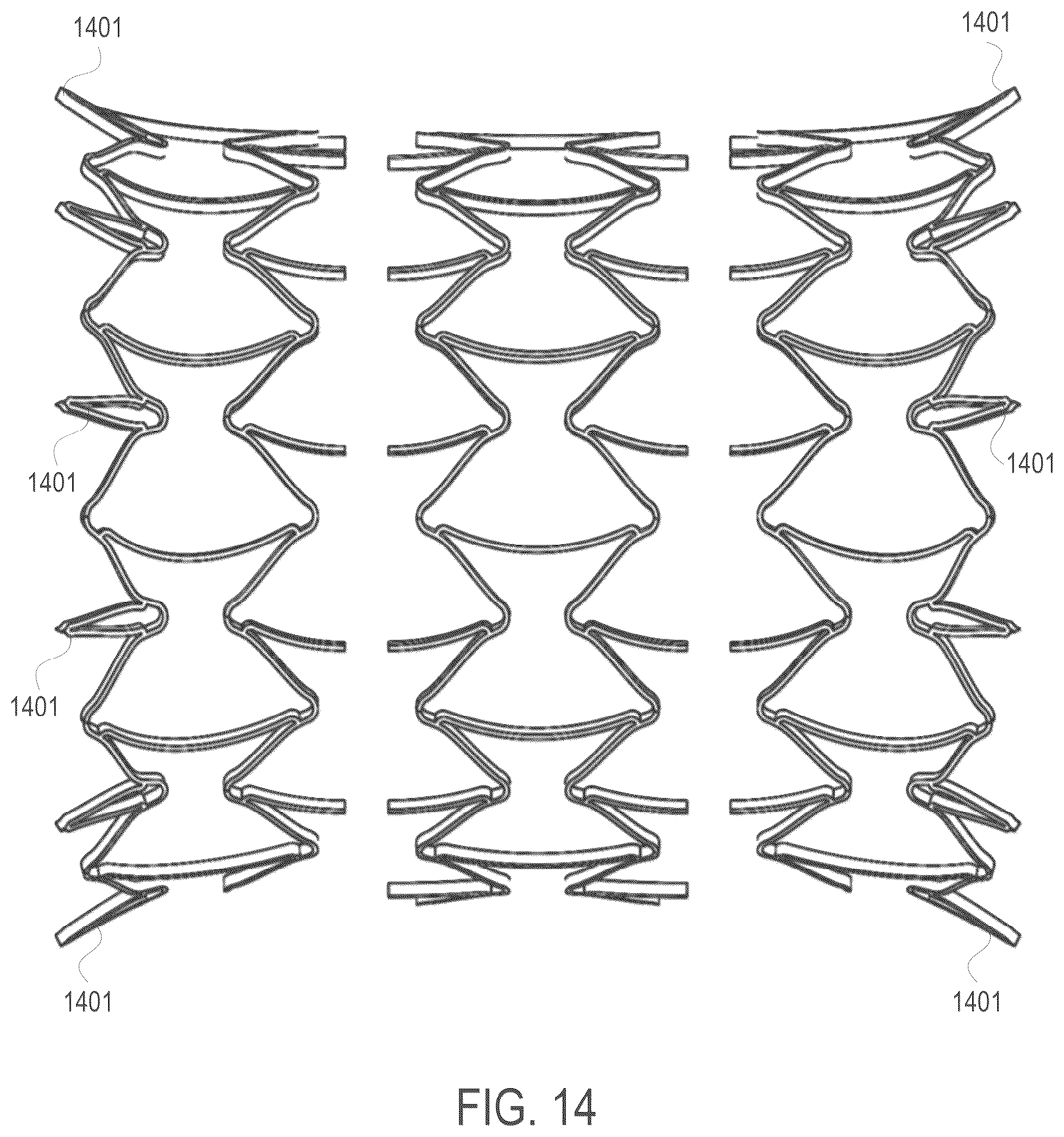 Patent US12508139 Figure 11 – Auxetic stents for managing venous stenosis