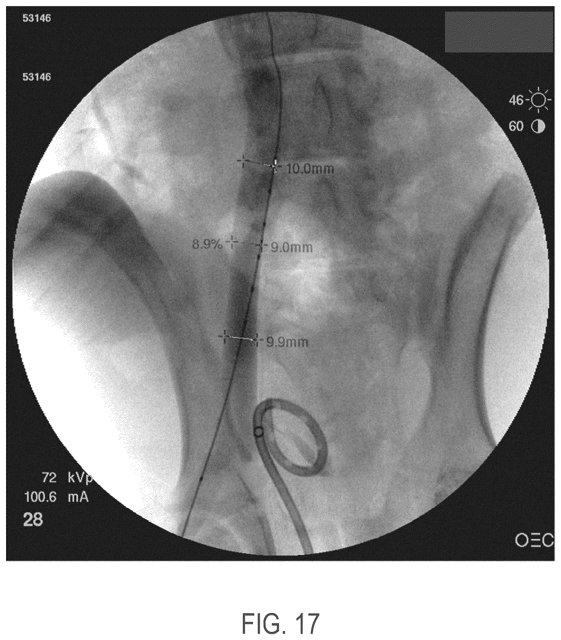 Patent US12508139 Figure 13 – Auxetic stents for managing venous stenosis