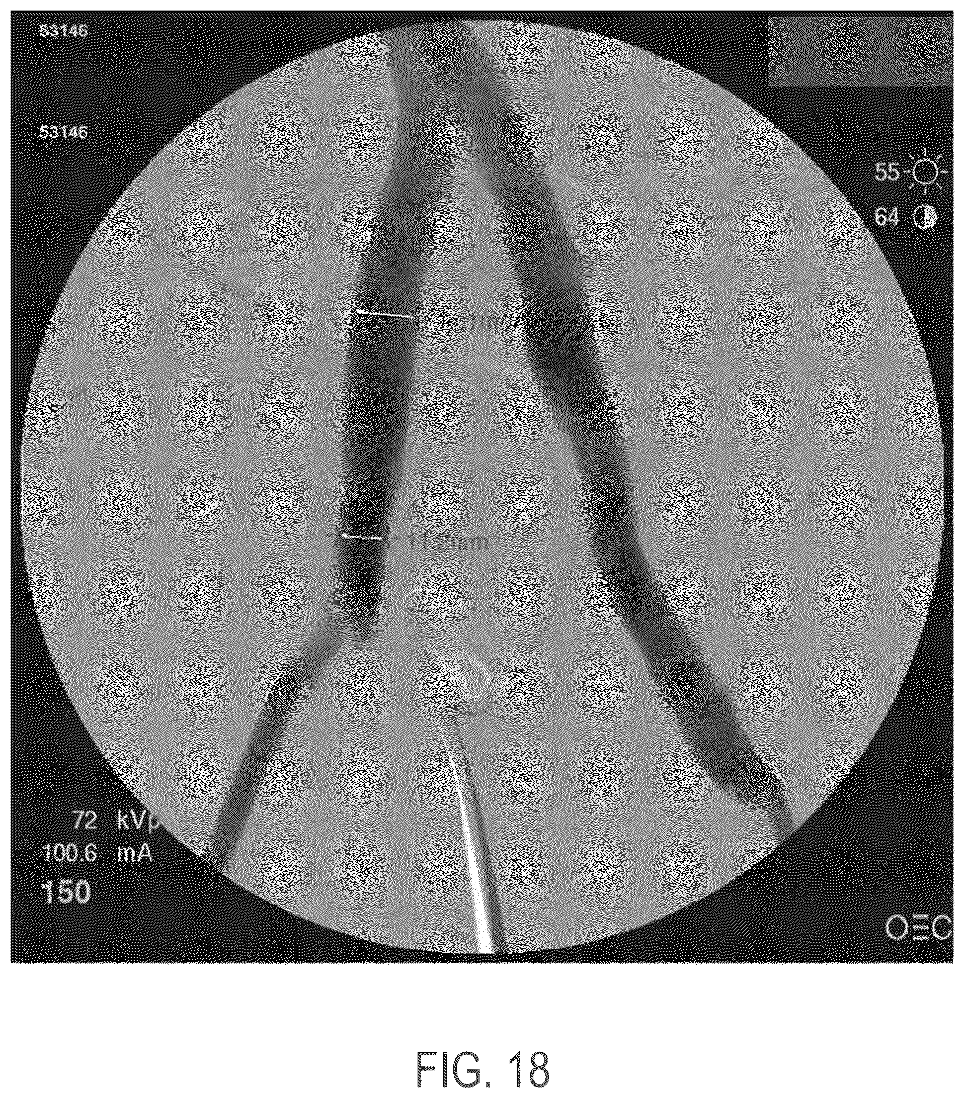 Patent US12508139 Figure 14 – Auxetic stents for managing venous stenosis