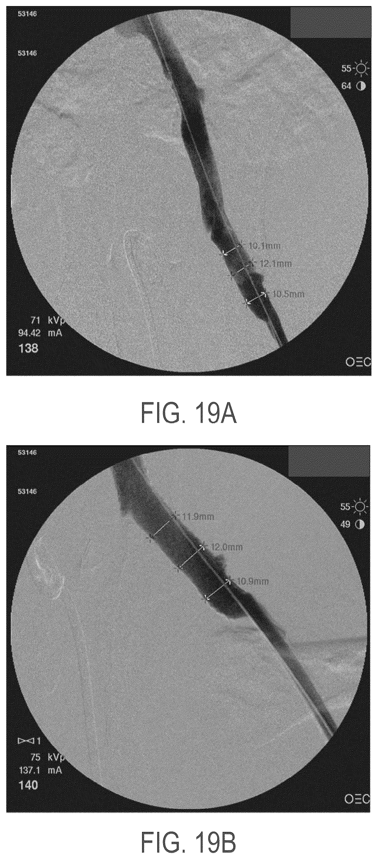 Patent US12508139 Figure 15 – Auxetic stents for managing venous stenosis