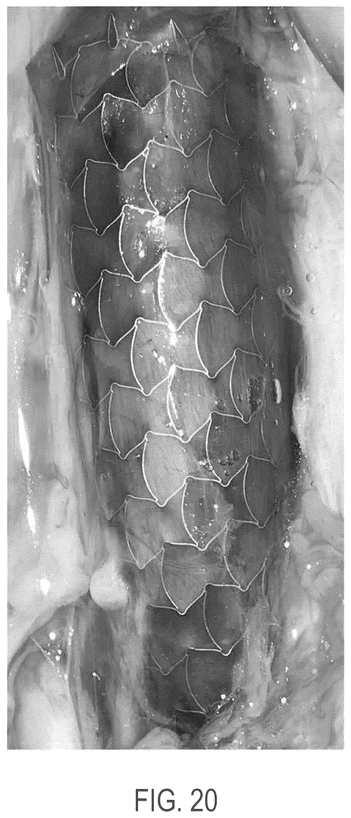 Patent US12508139 Figure 16 – Auxetic stents for managing venous stenosis