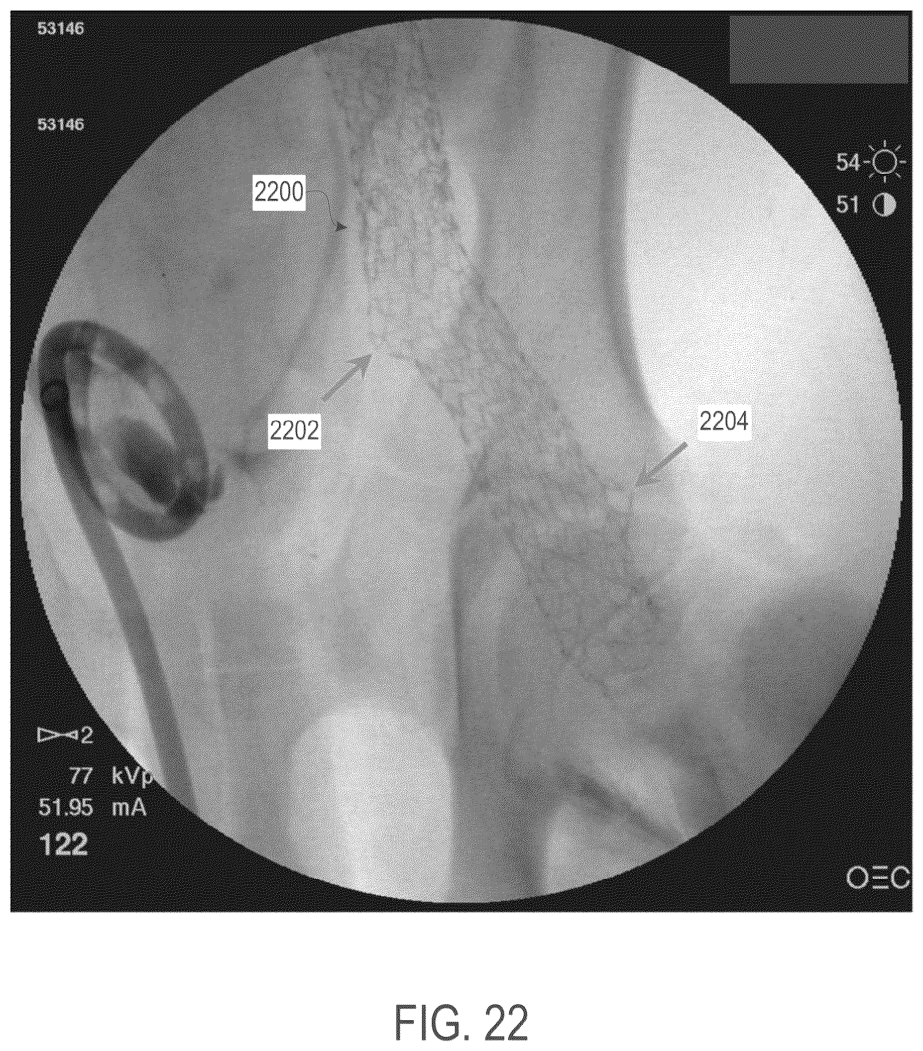 Patent US12508139 Figure 18 – Auxetic stents for managing venous stenosis