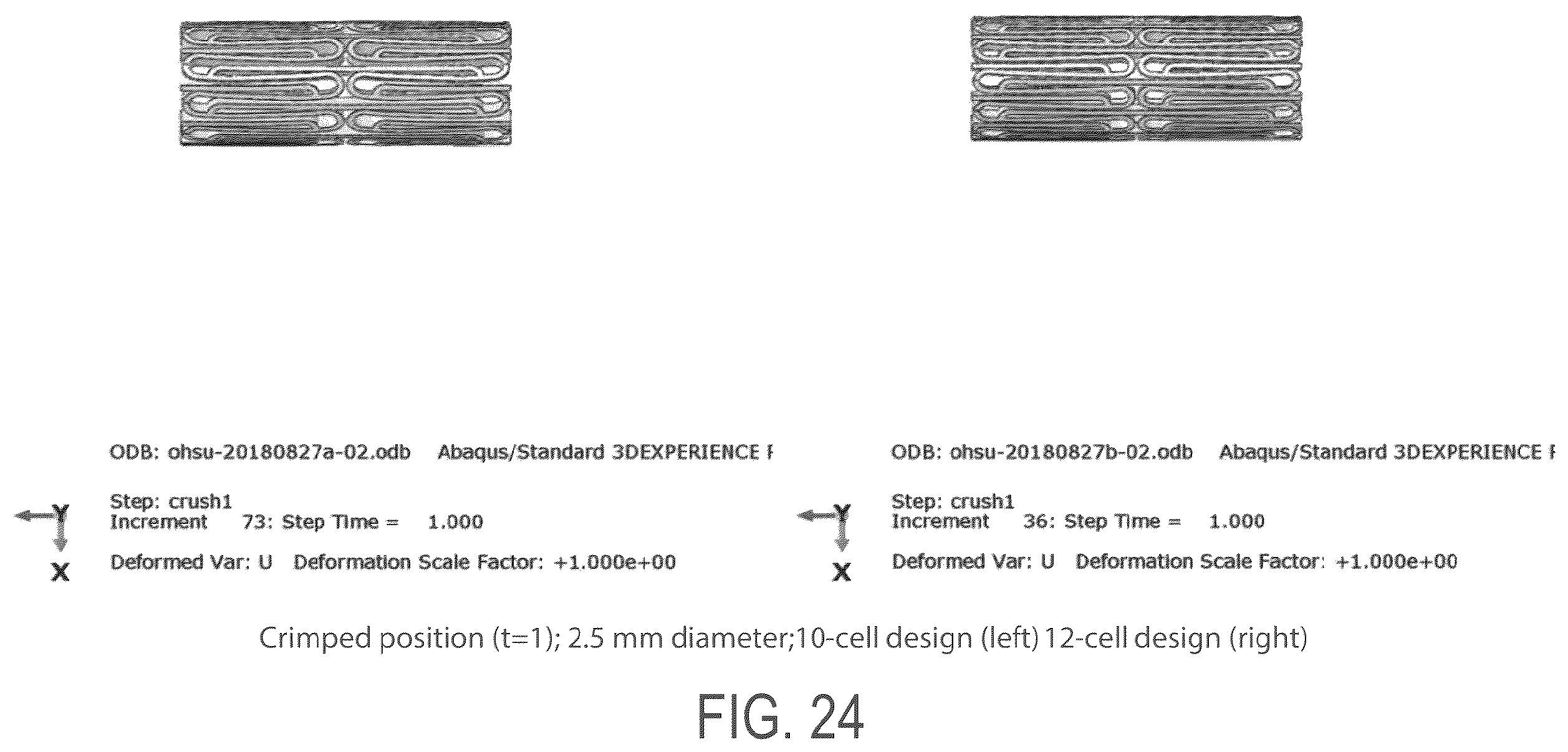 Patent US12508139 Figure 20 – Auxetic stents for managing venous stenosis
