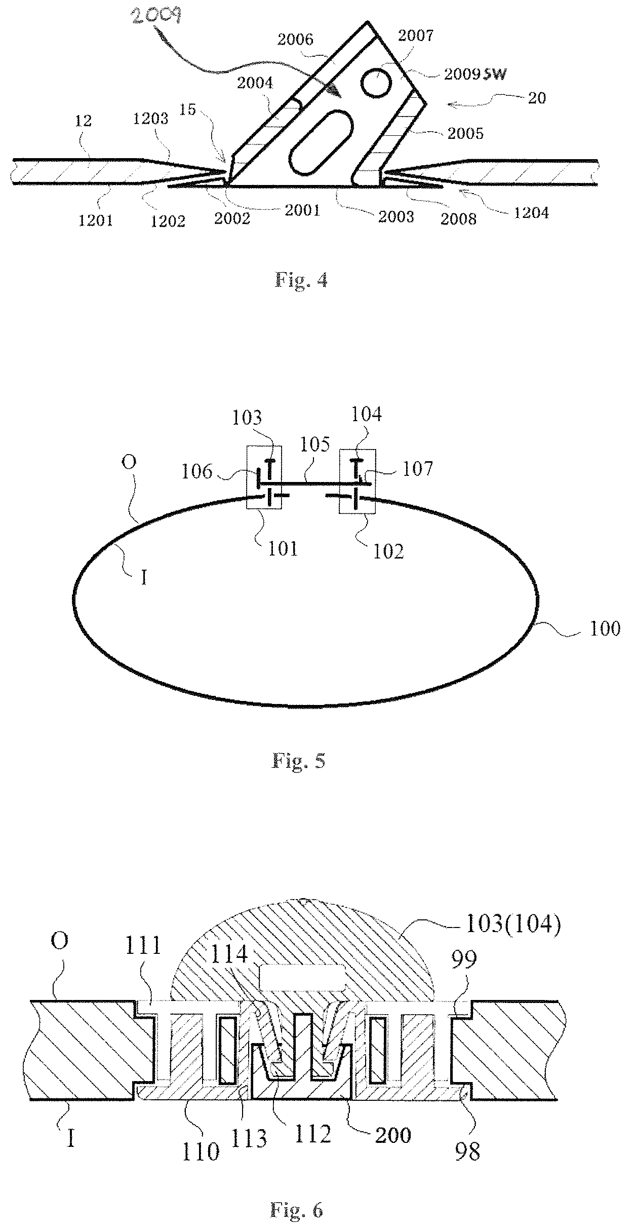Patent US12508148 Figure 3 – Easily formed arm external fixing brace