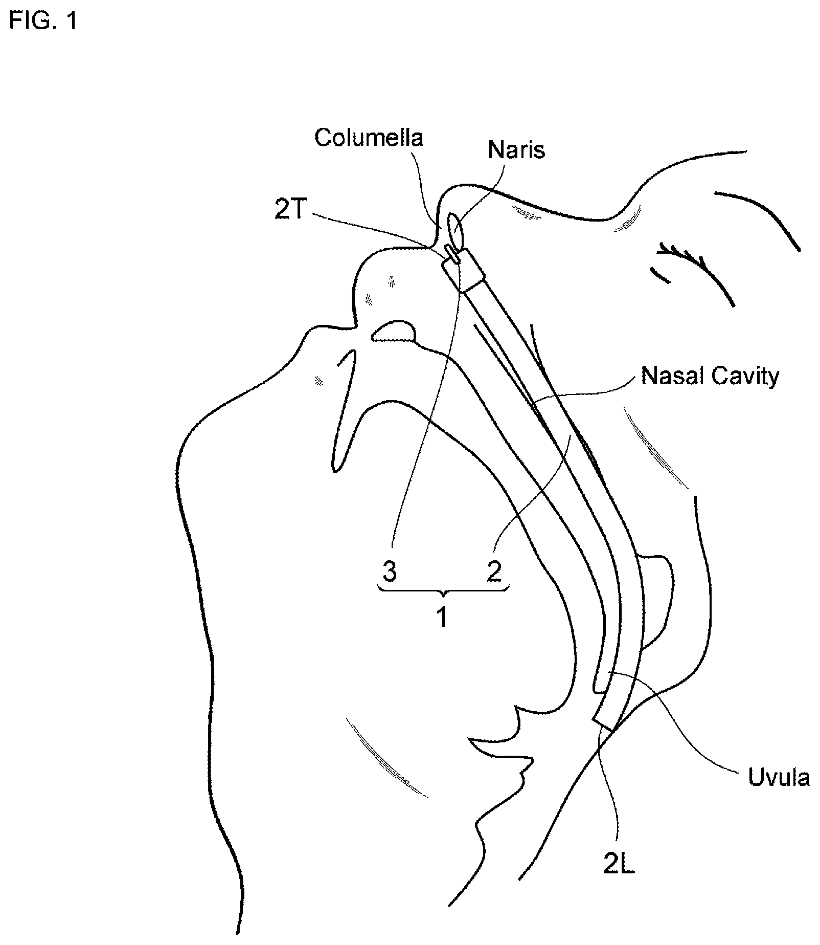 Patent US12508149 Figure 1 – Nasal cavity insertion device