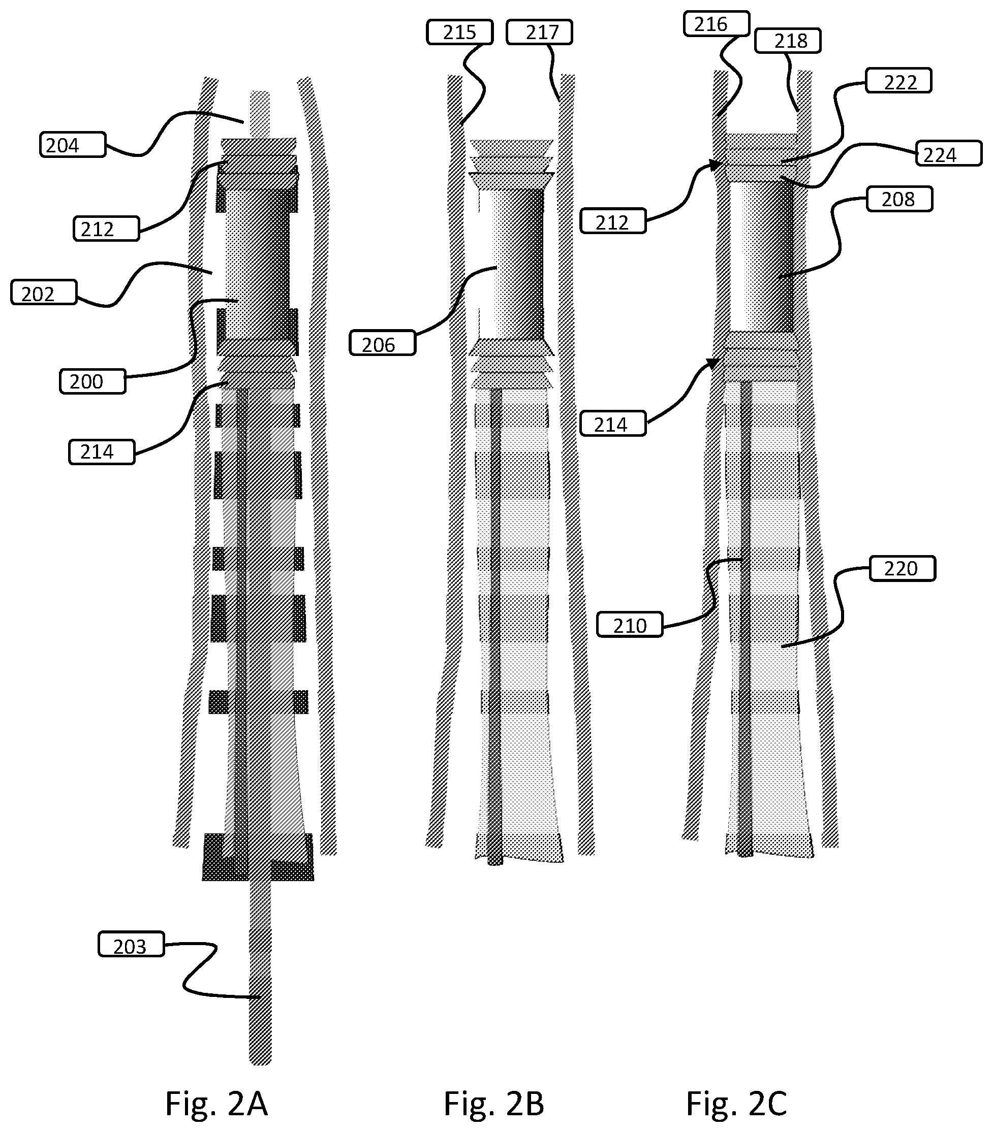 Patent US12508151 Figure 2 – Devices and methods for anchoring a sheath in a tissue cavity