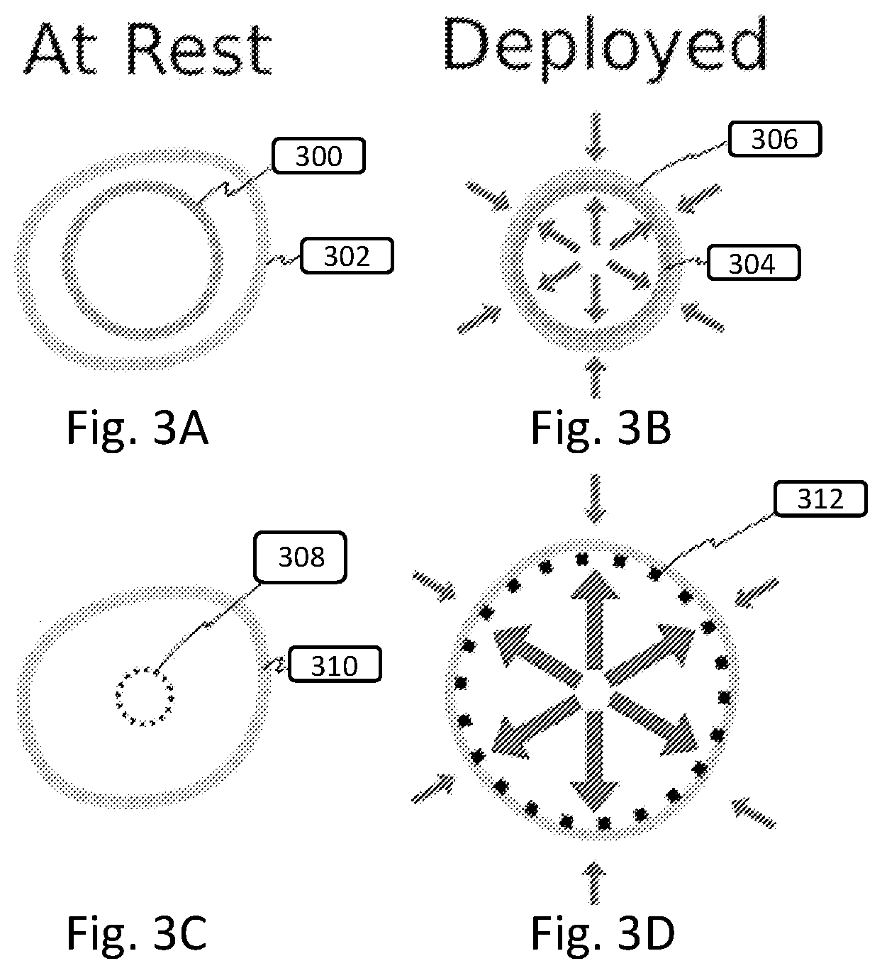 Patent US12508151 Figure 3 – Devices and methods for anchoring a sheath in a tissue cavity