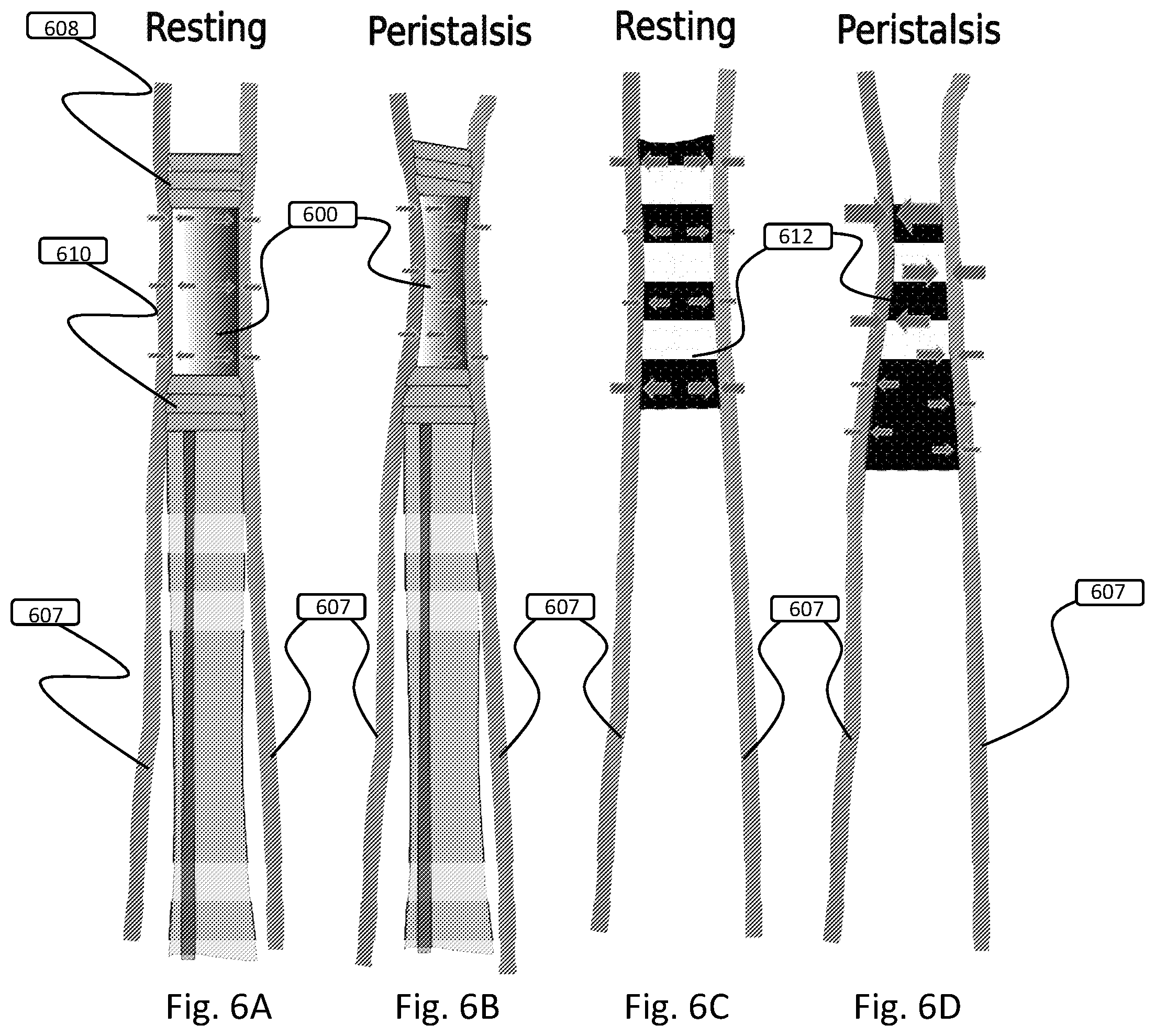 Patent US12508151 Figure 6 – Devices and methods for anchoring a sheath in a tissue cavity
