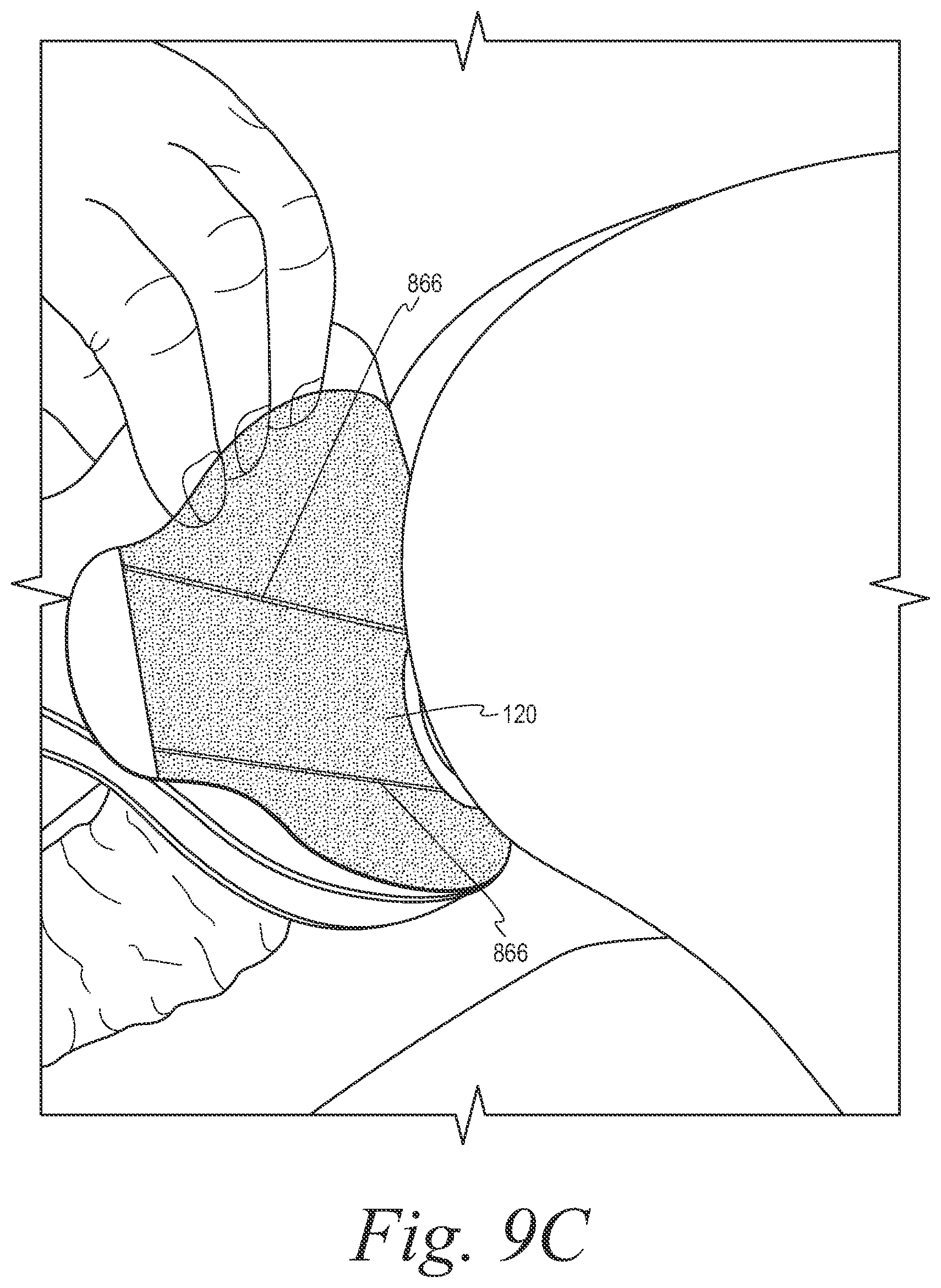 Patent US12508153 Figure 11 – Fecal collection systems and methods