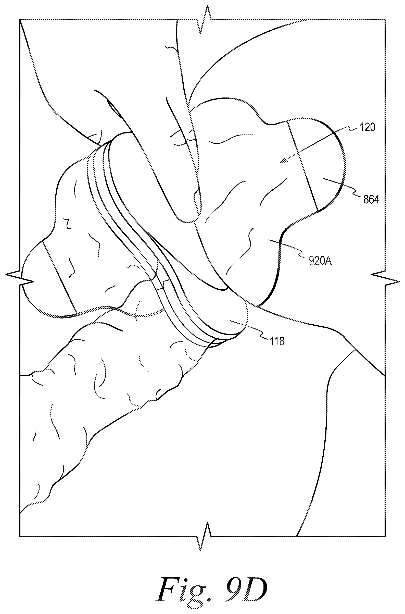 Patent US12508153 Figure 12 – Fecal collection systems and methods
