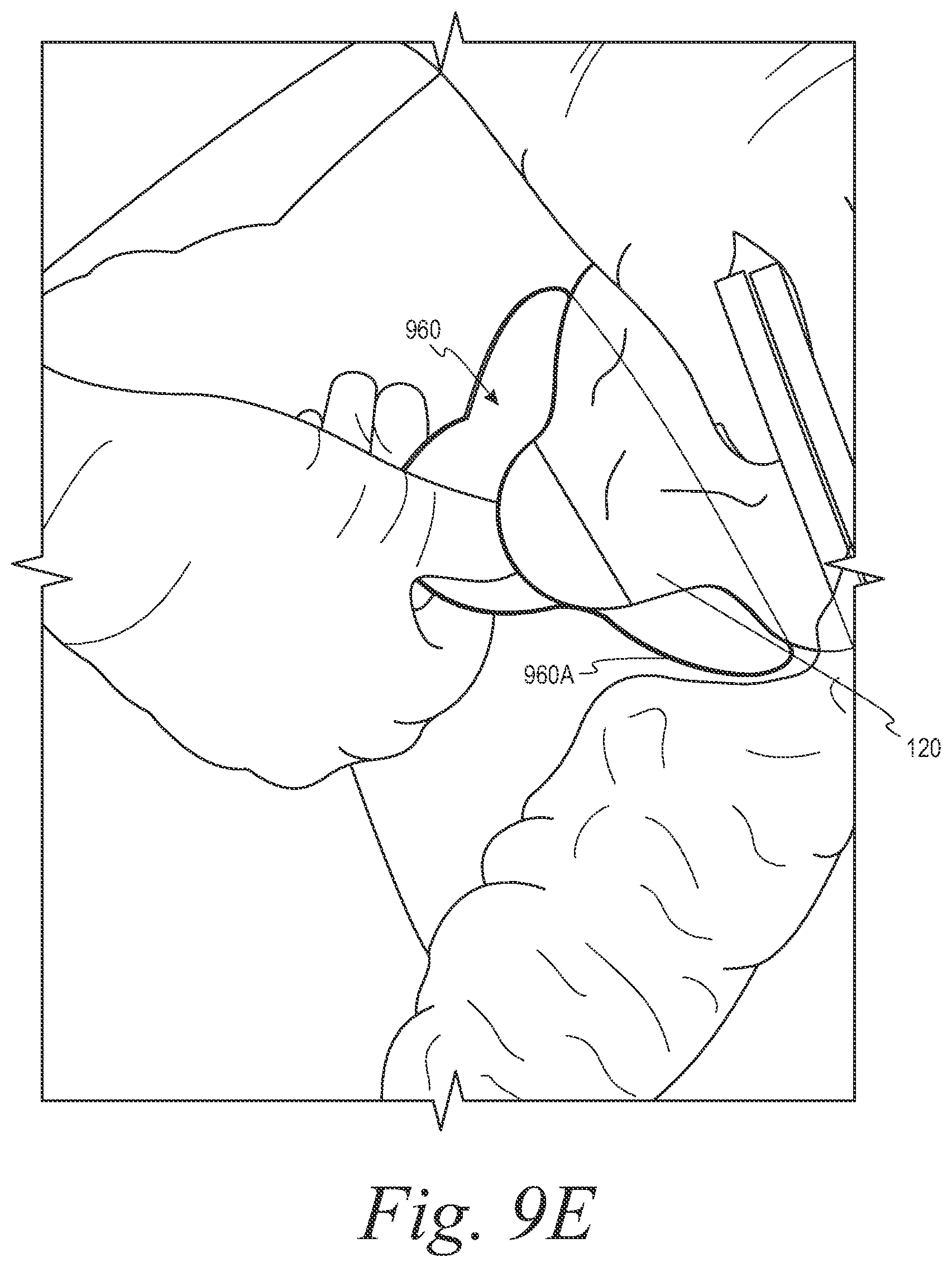 Patent US12508153 Figure 13 – Fecal collection systems and methods
