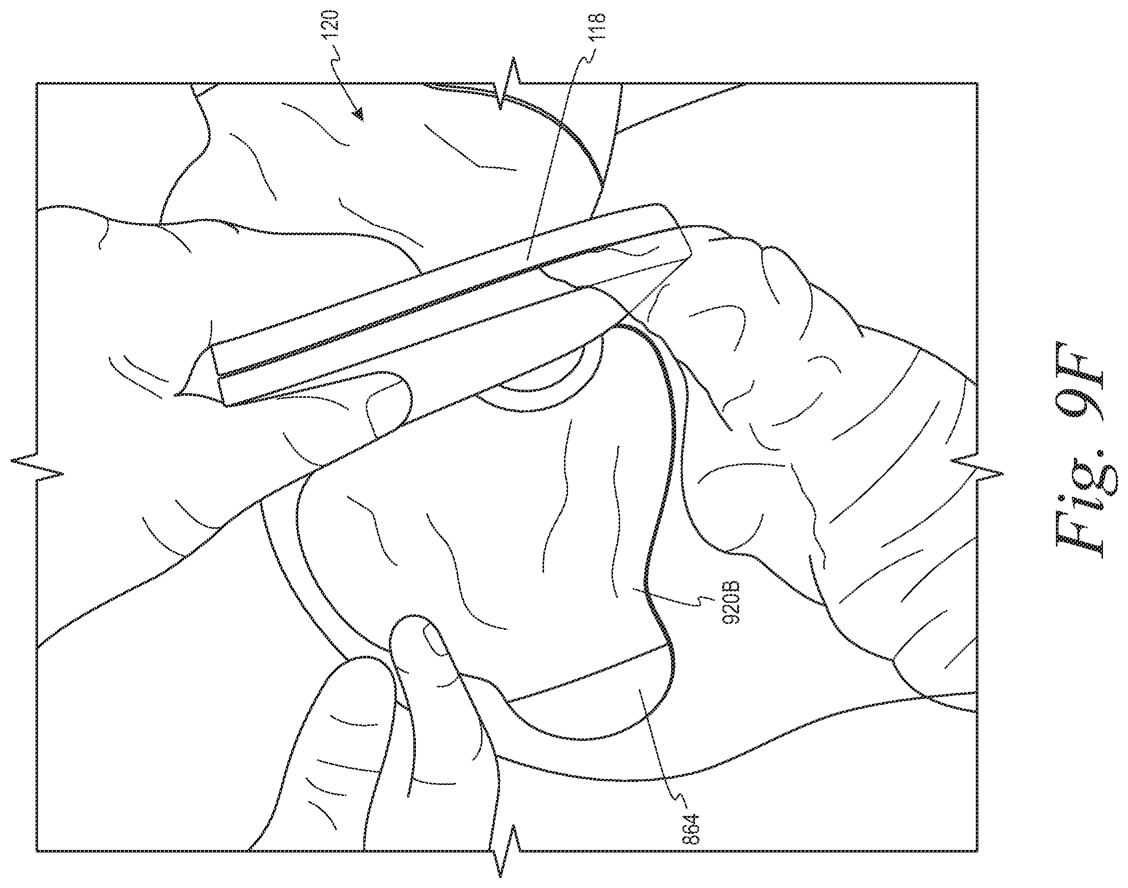Patent US12508153 Figure 14 – Fecal collection systems and methods