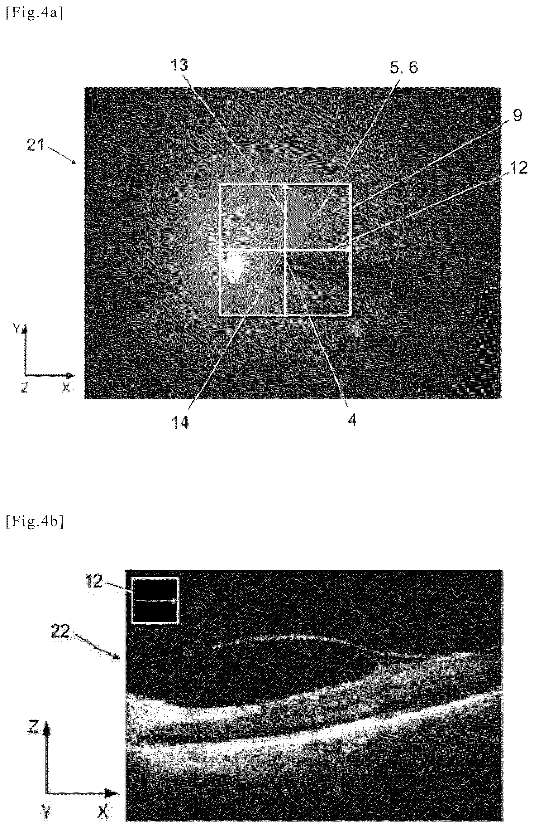 Patent US12508157 Figure 3 – Medical device for eye surgery