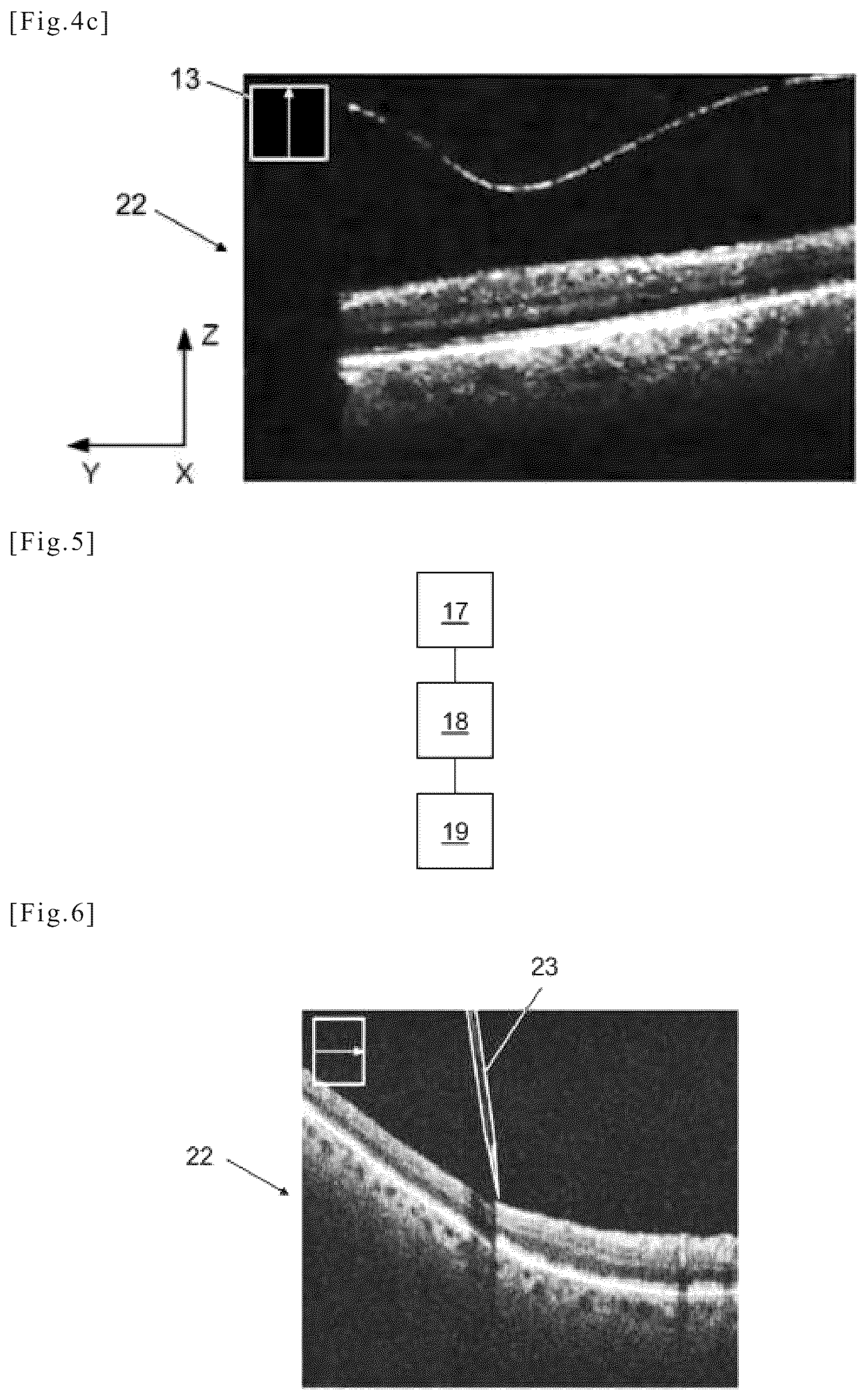 Patent US12508157 Figure 4 – Medical device for eye surgery