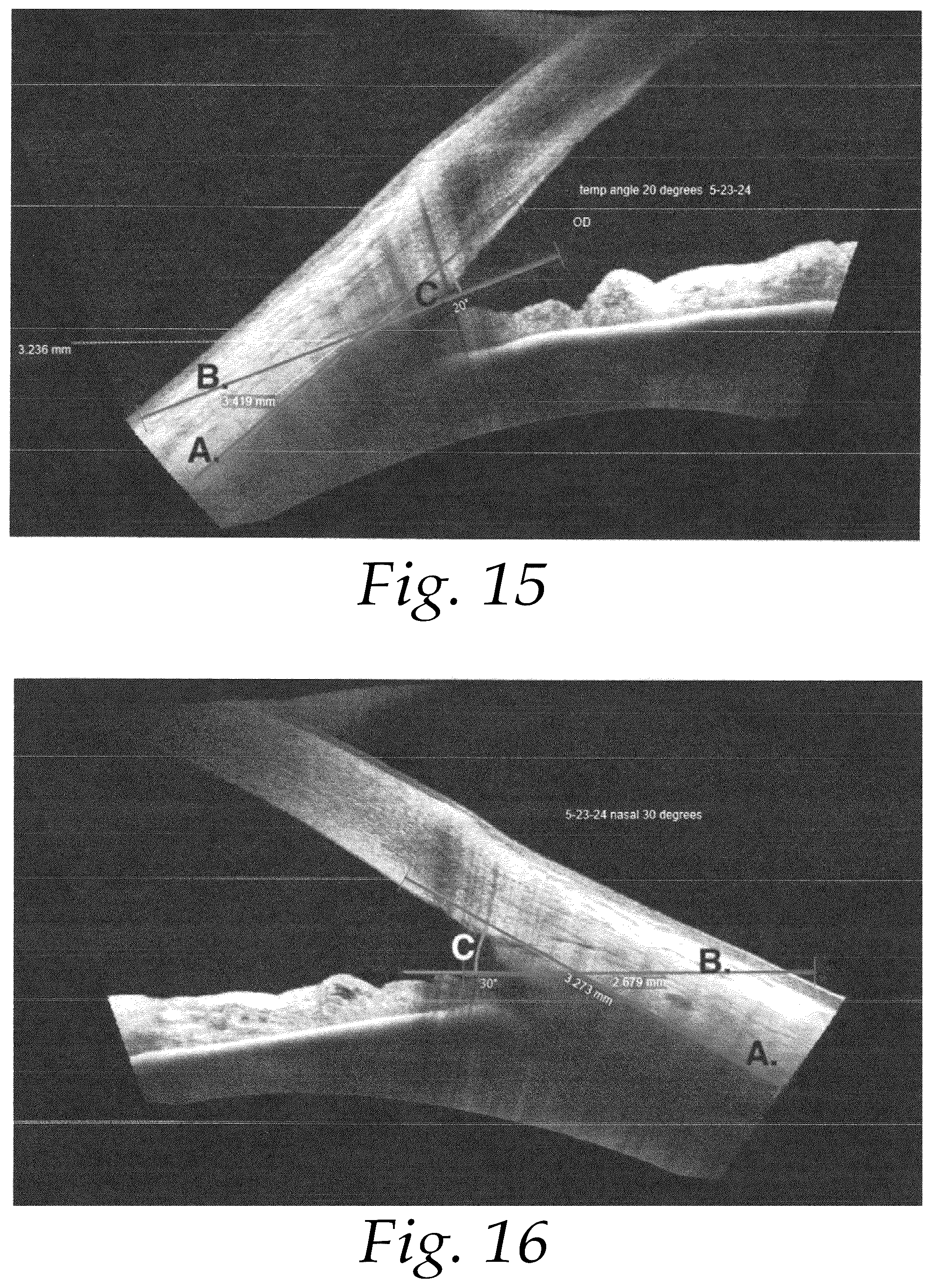 Patent US12508160 Figure 12 – Methods for treating glaucoma