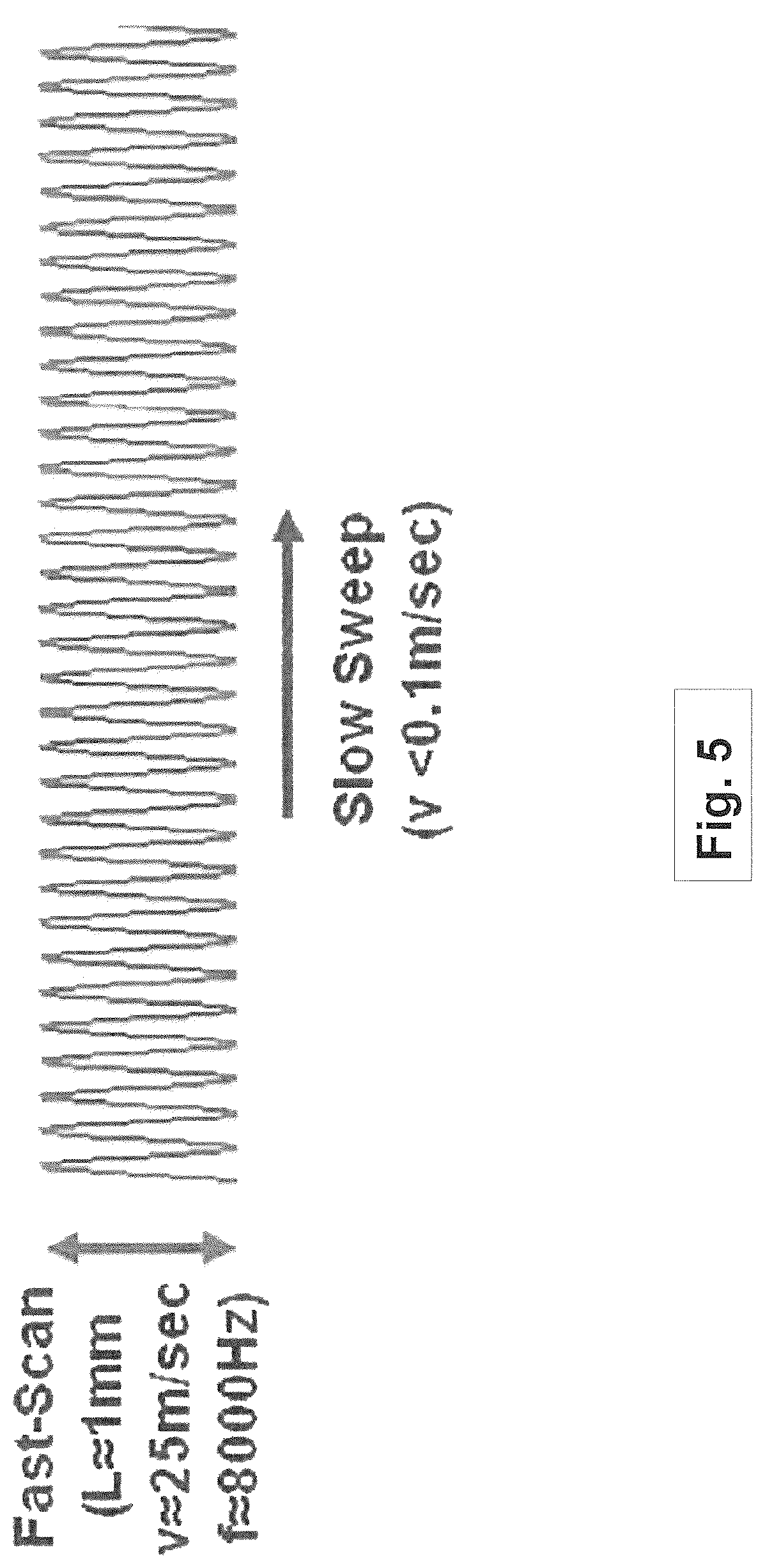 Patent US12508163 Figure 5 – Systems and methods for lenticular laser incision