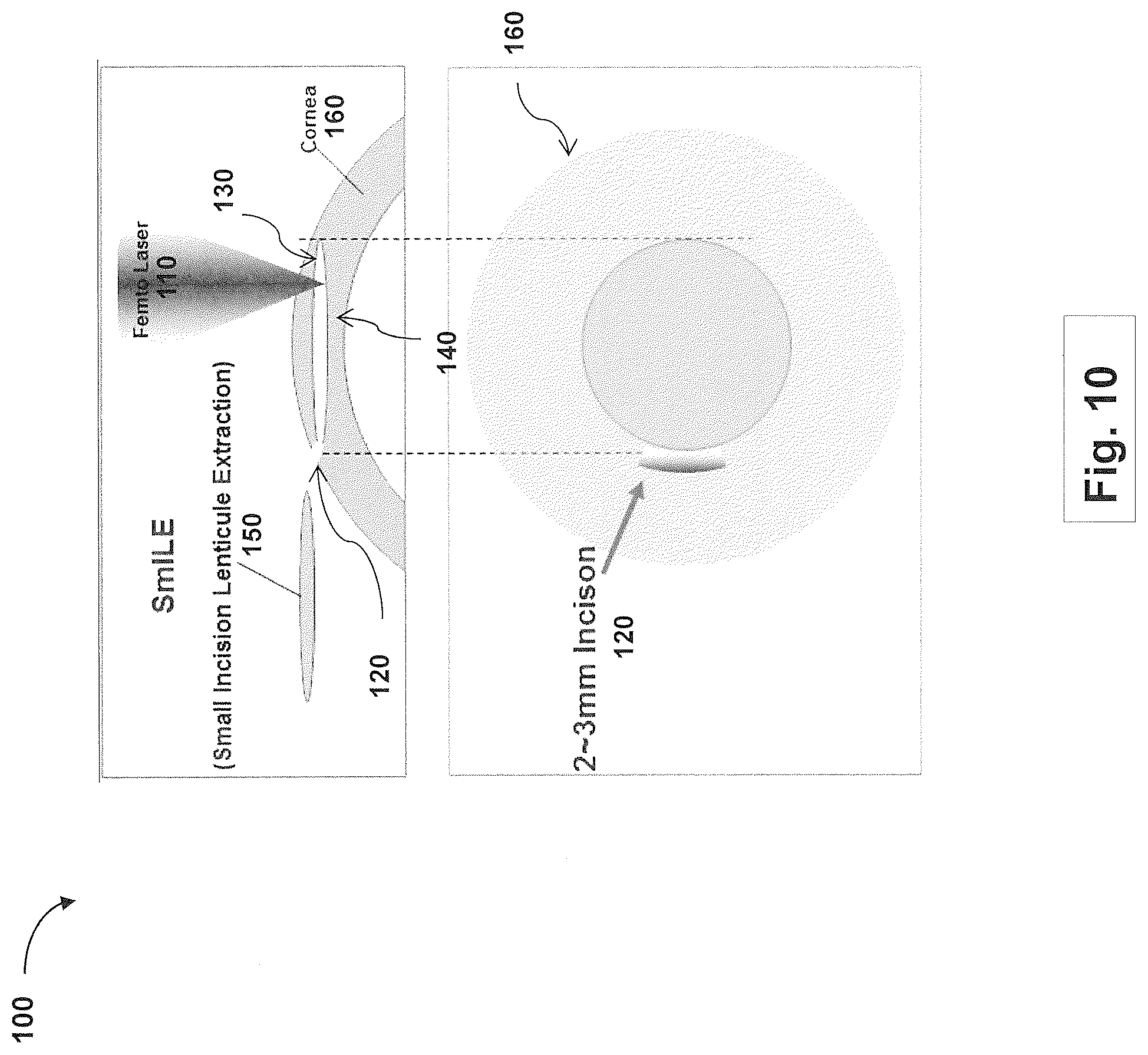 Patent US12508163 Figure 10 – Systems and methods for lenticular laser incision