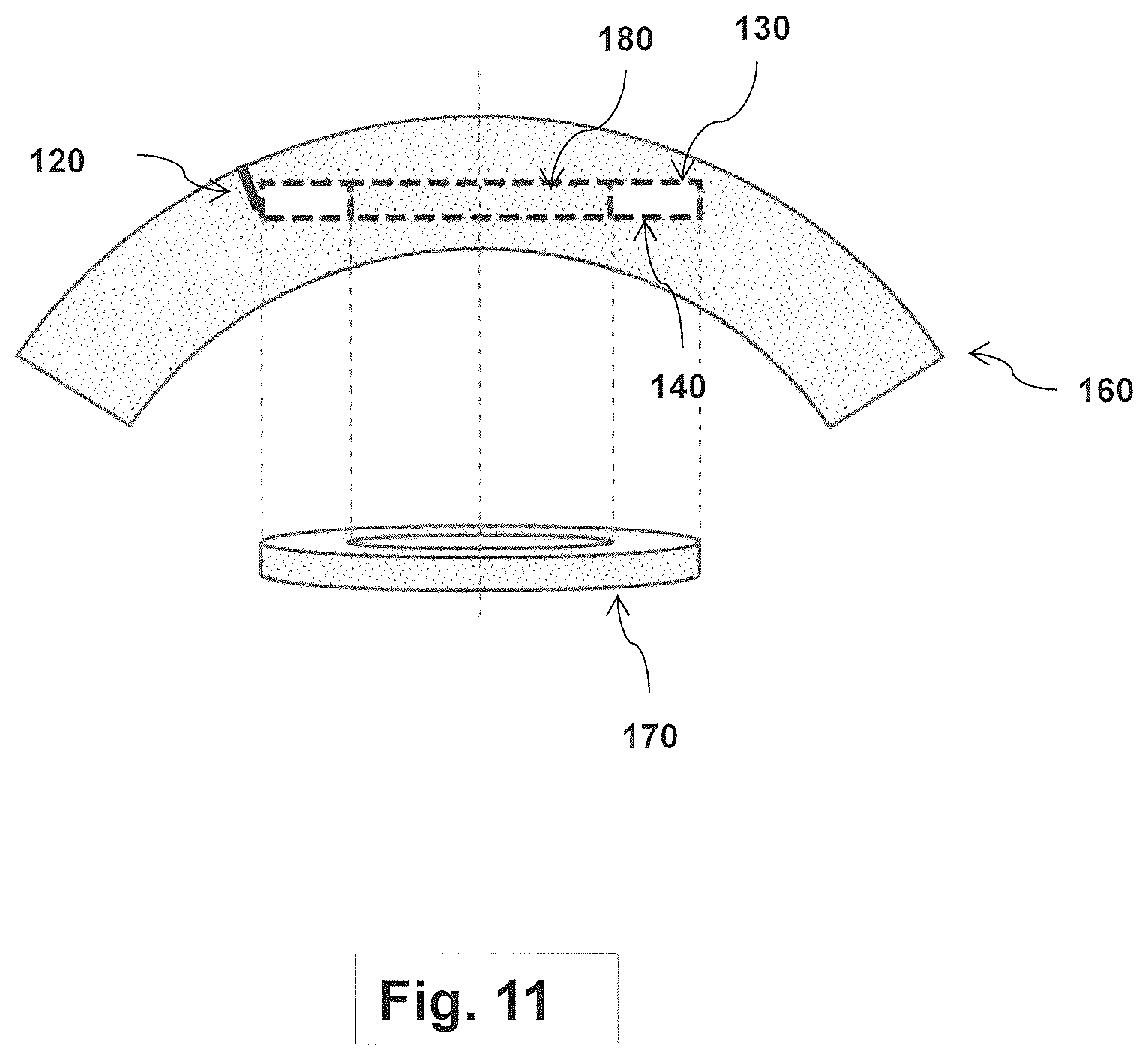 Patent US12508163 Figure 11 – Systems and methods for lenticular laser incision