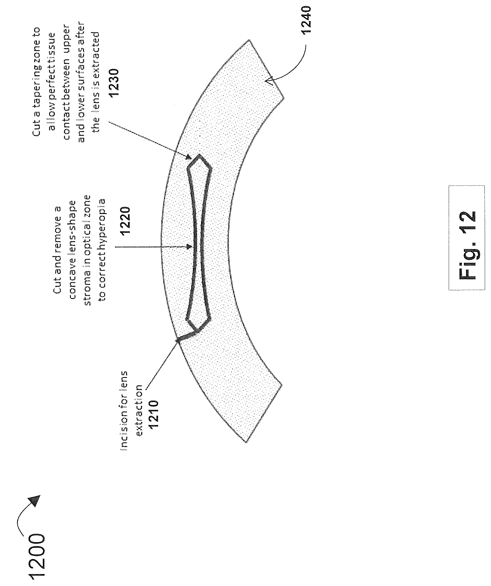 Patent US12508163 Figure 12 – Systems and methods for lenticular laser incision