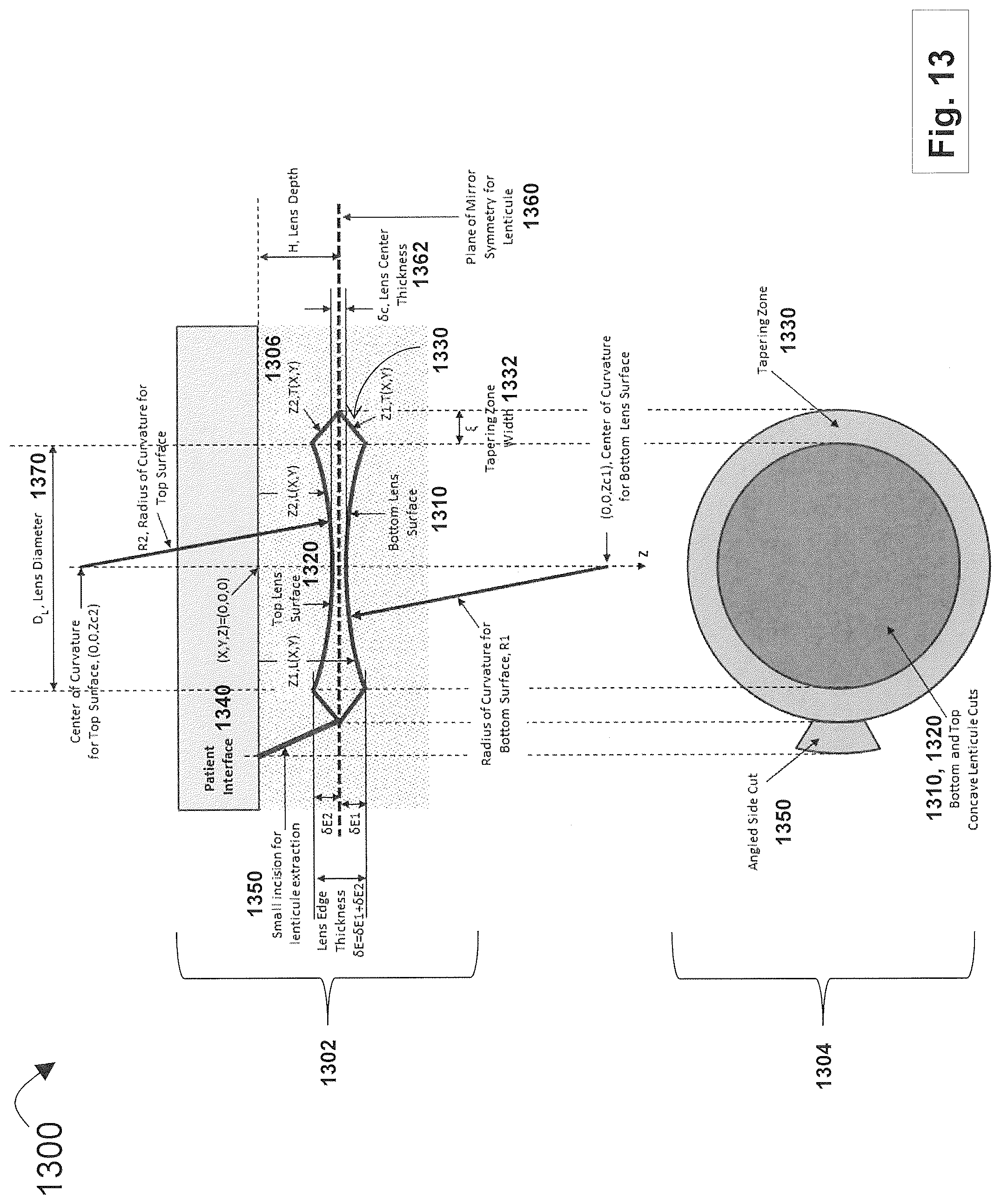 Patent US12508163 Figure 13 – Systems and methods for lenticular laser incision