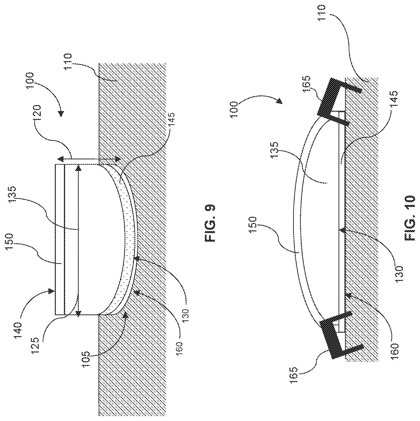Patent US12508166 Figure 5 – Wound bolster dressing and method of use