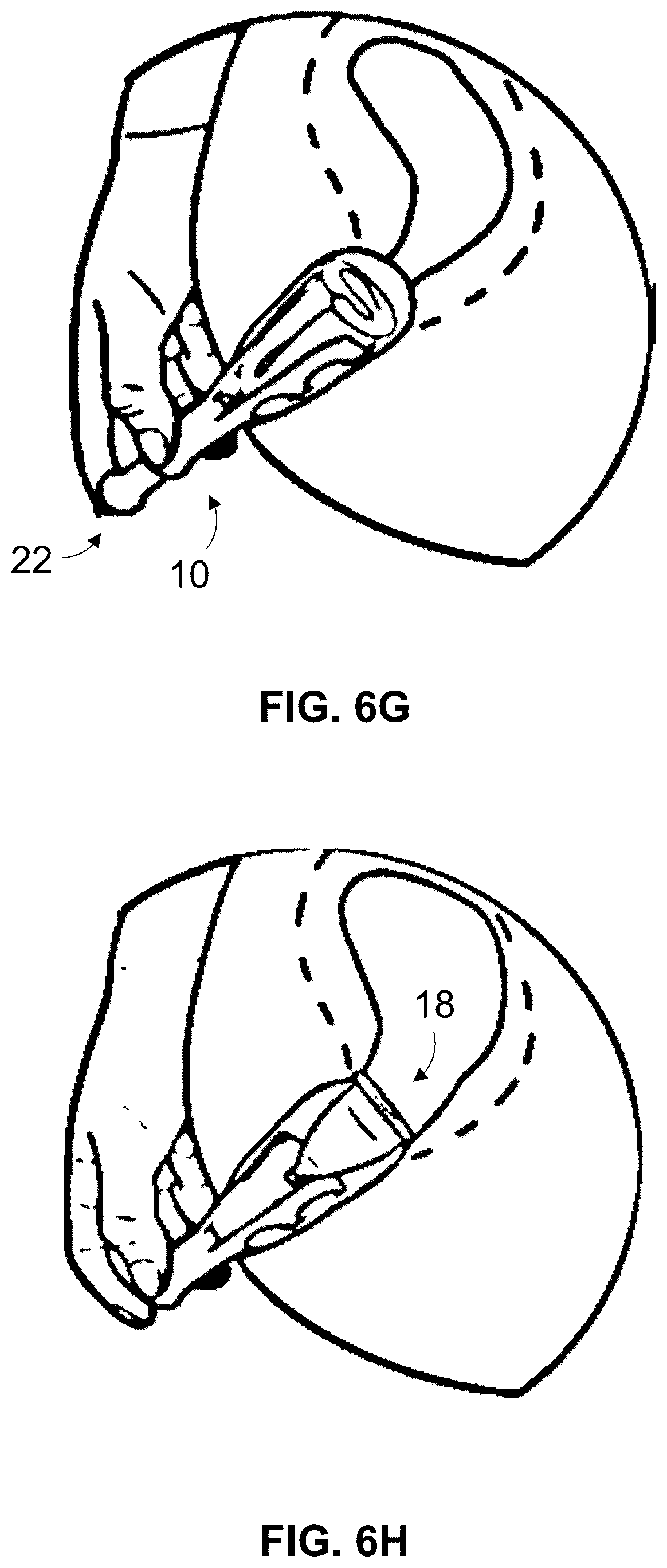 Patent US12508170 Figure 20 – Menstrual cup applicators and methods of using the same