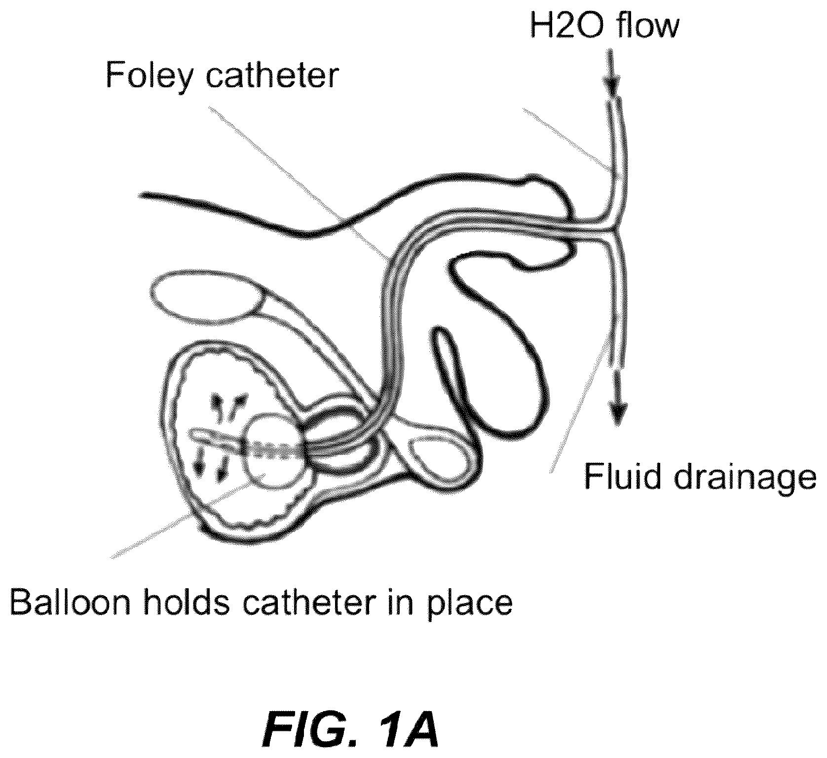 Patent US12508171 Figure 1 – Delivery systems for control of bleeding in transurethral prostatectomy