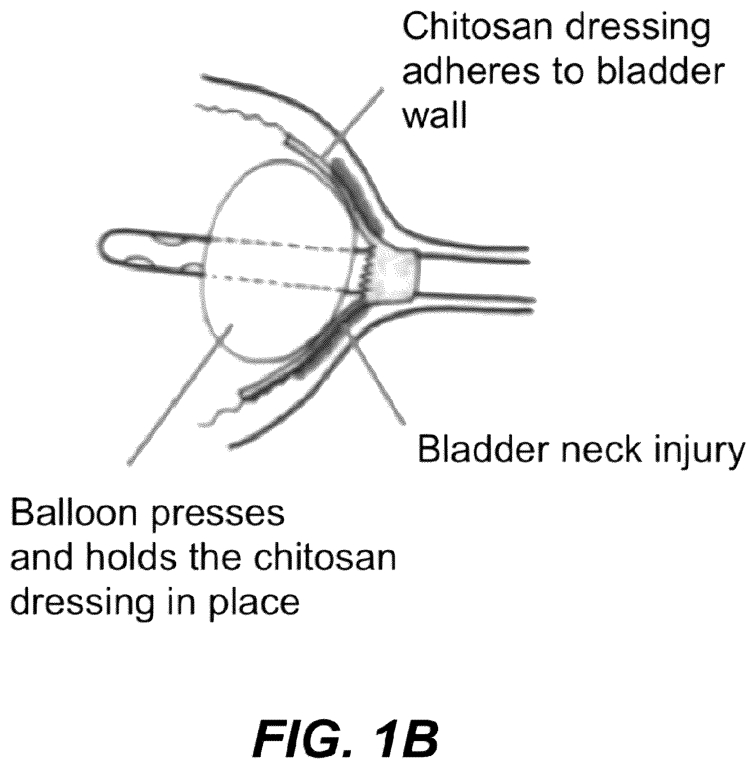 Patent US12508171 Figure 2 – Delivery systems for control of bleeding in transurethral prostatectomy