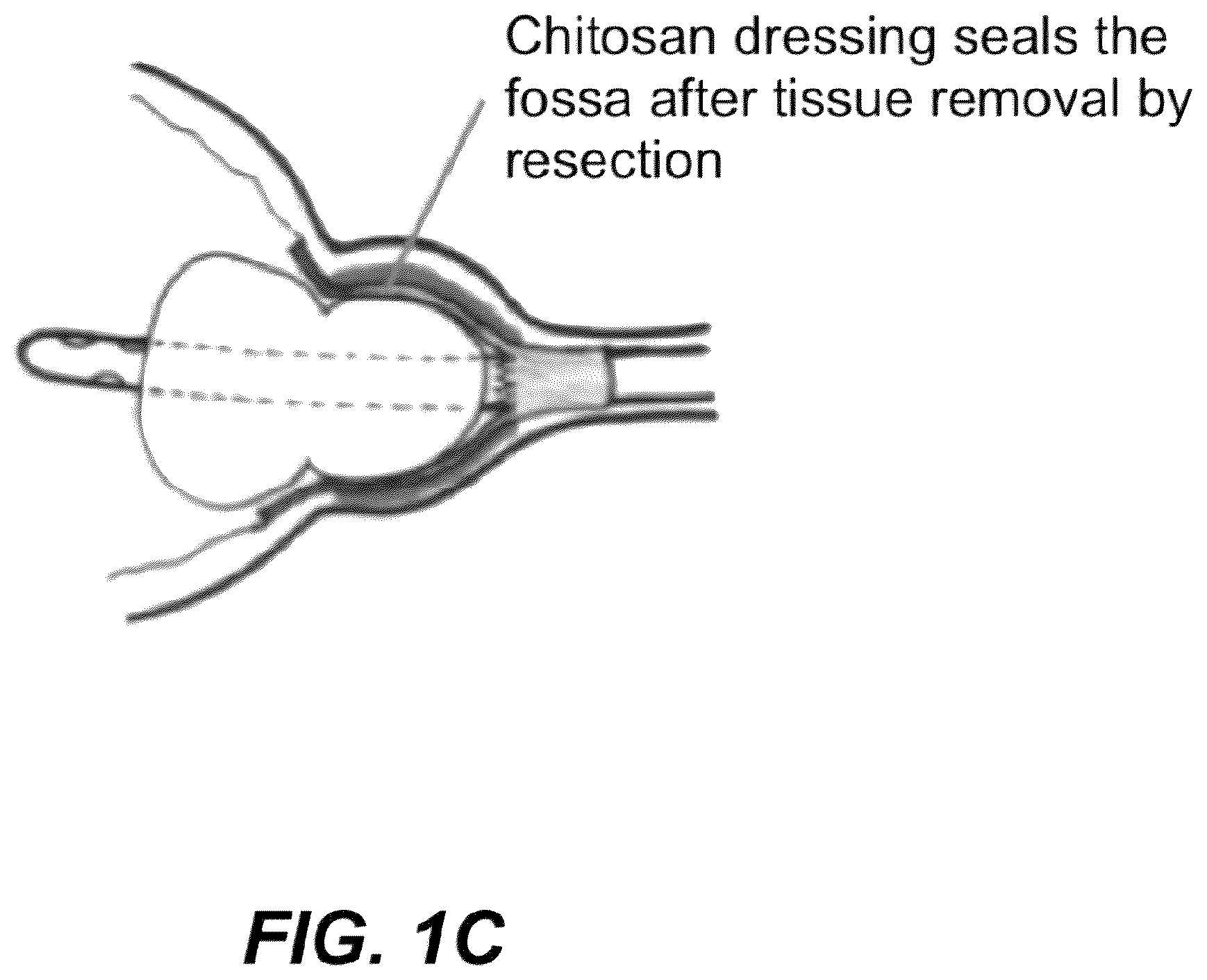Patent US12508171 Figure 3 – Delivery systems for control of bleeding in transurethral prostatectomy