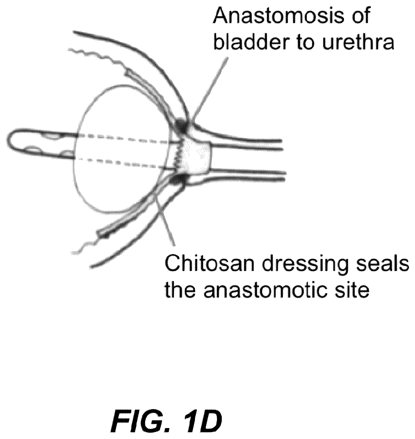 Patent US12508171 Figure 4 – Delivery systems for control of bleeding in transurethral prostatectomy