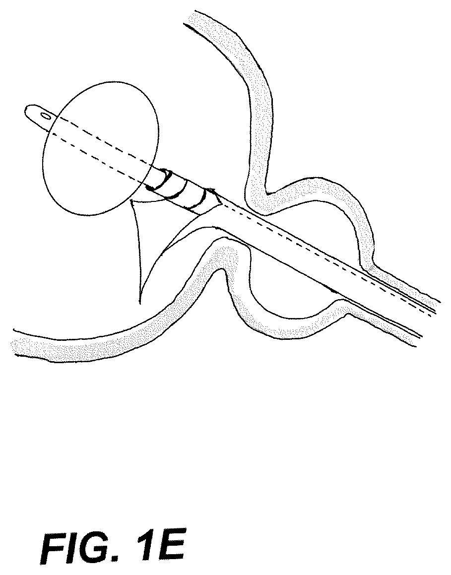 Patent US12508171 Figure 5 – Delivery systems for control of bleeding in transurethral prostatectomy