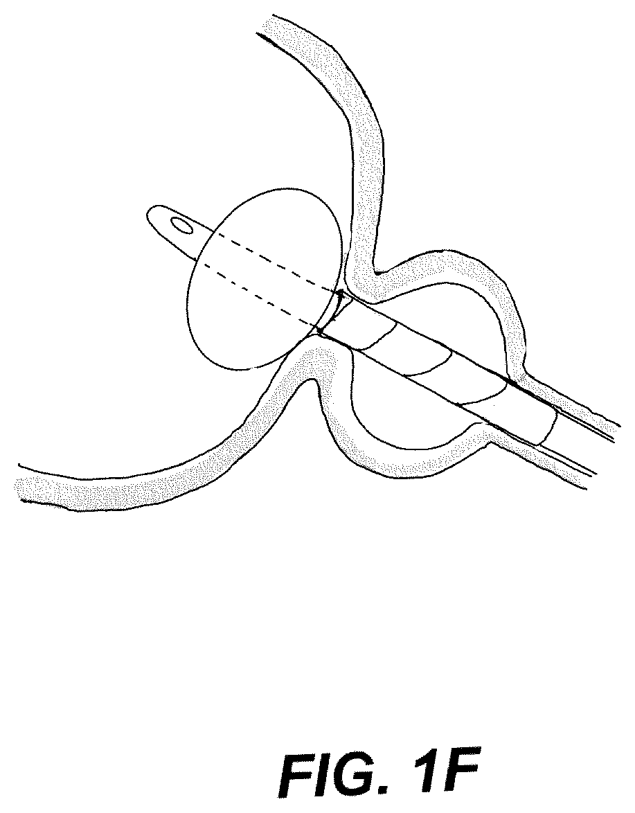 Patent US12508171 Figure 6 – Delivery systems for control of bleeding in transurethral prostatectomy