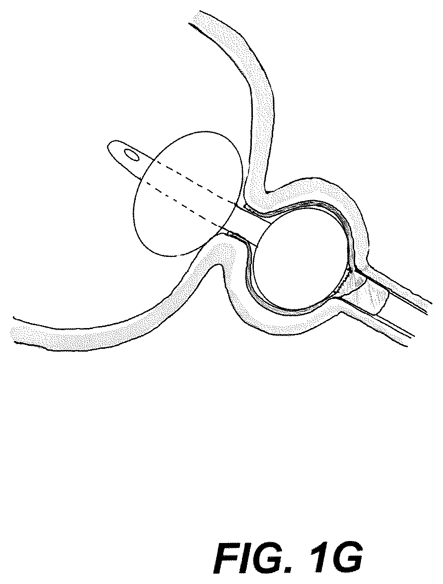 Patent US12508171 Figure 7 – Delivery systems for control of bleeding in transurethral prostatectomy