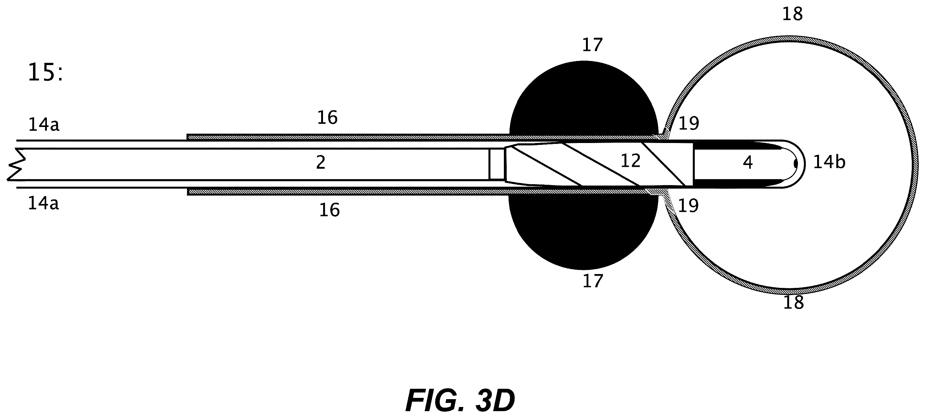 Patent US12508171 Figure 16 – Delivery systems for control of bleeding in transurethral prostatectomy