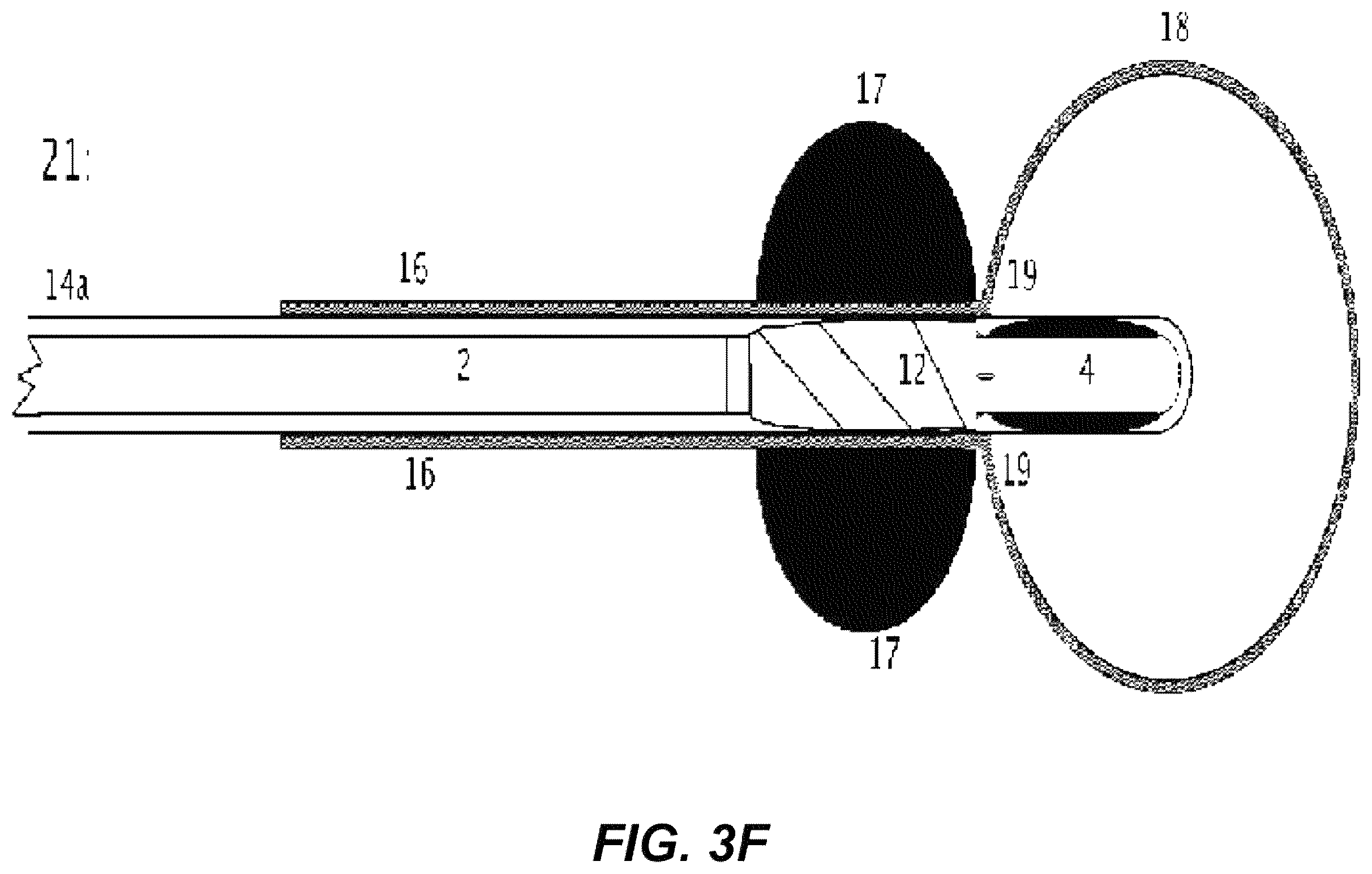 Patent US12508171 Figure 18 – Delivery systems for control of bleeding in transurethral prostatectomy