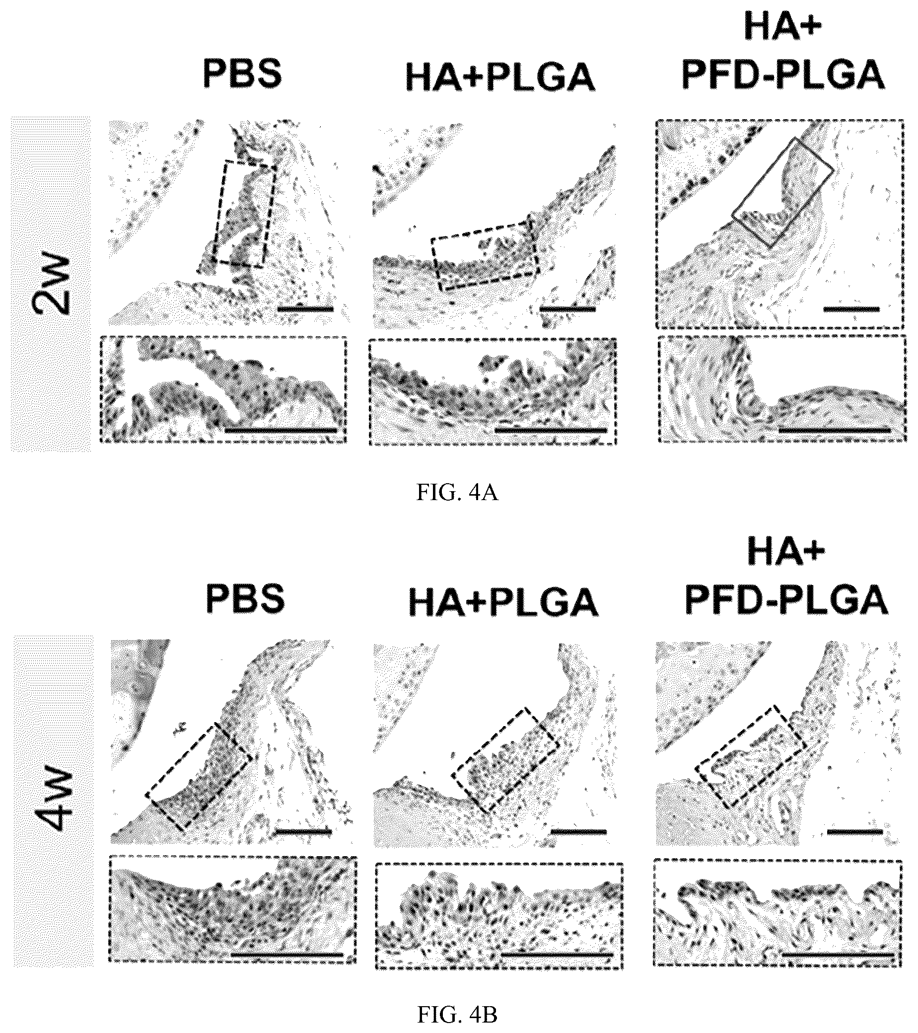 Patent US12508228 Figure 4 – PFD loaded microspheres and method for preparing injectable composite microsphere hydrogel solution from same