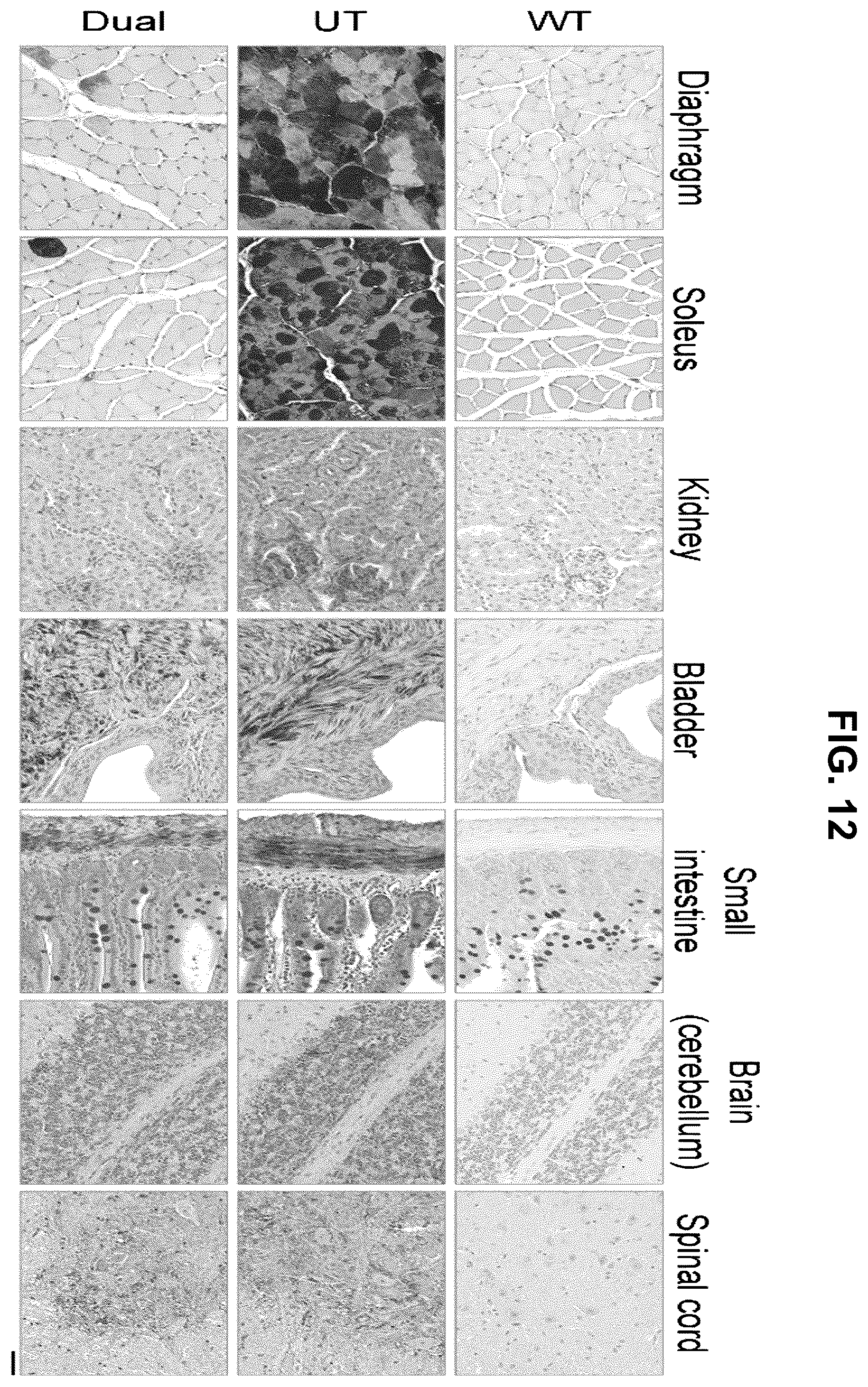 Patent US12508305 Figure 14 – Compositions and methods for treating and/or preventing glycogen storage disease type III