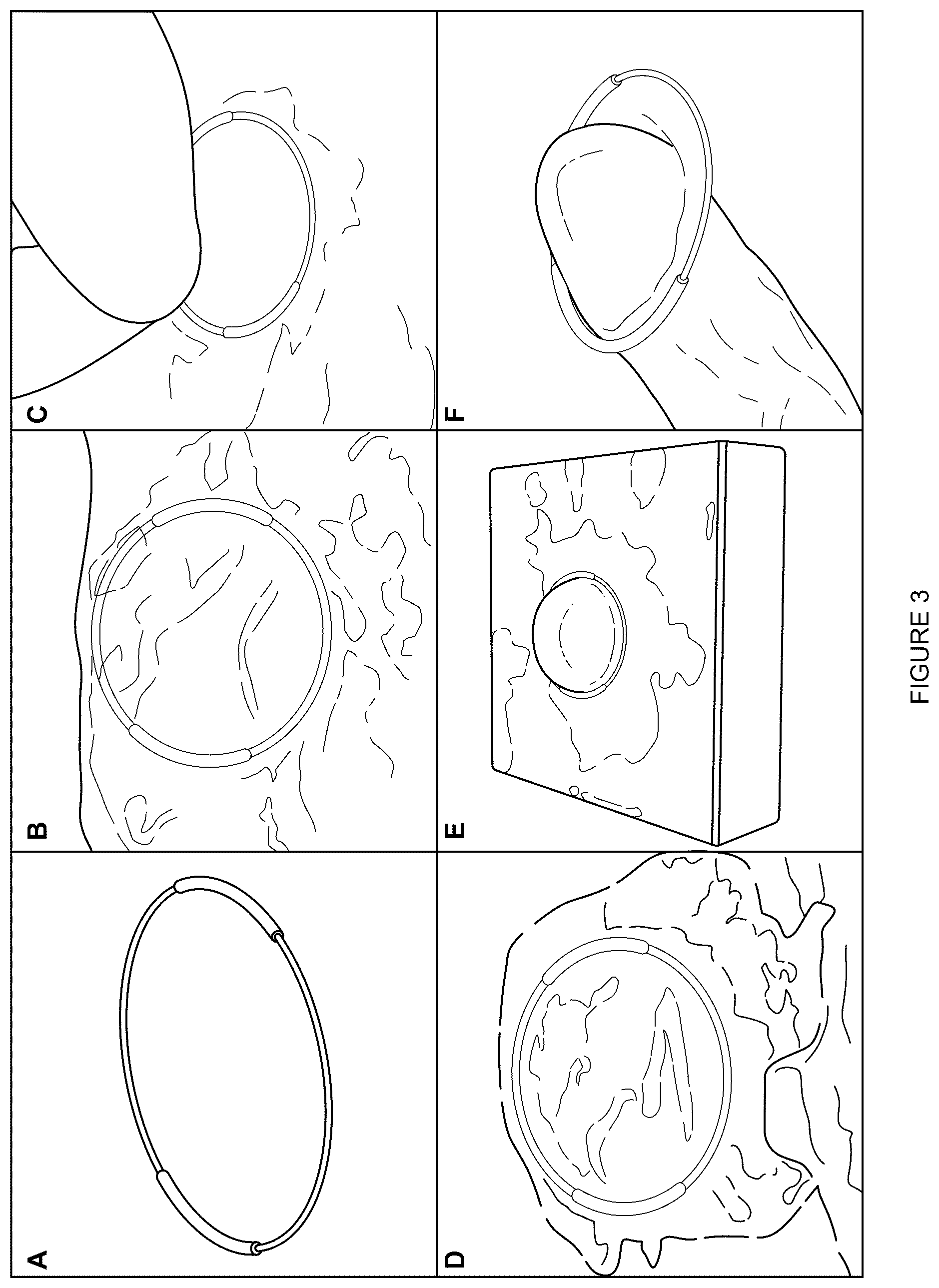 Patent US12508349 Figure 3 – Apparatuses and methods for treating ophthalmic diseases and disorders