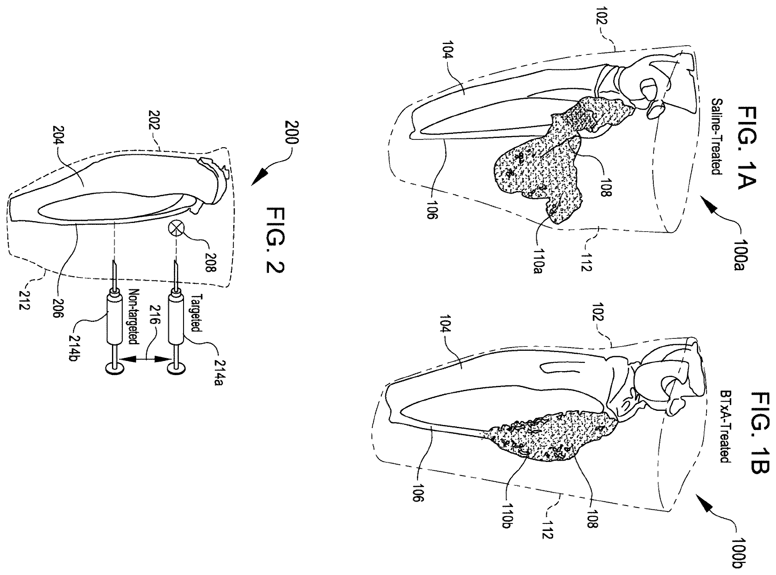 Patent US12508374 — Systems for inhibiting heterotopic ossification — Figure 1