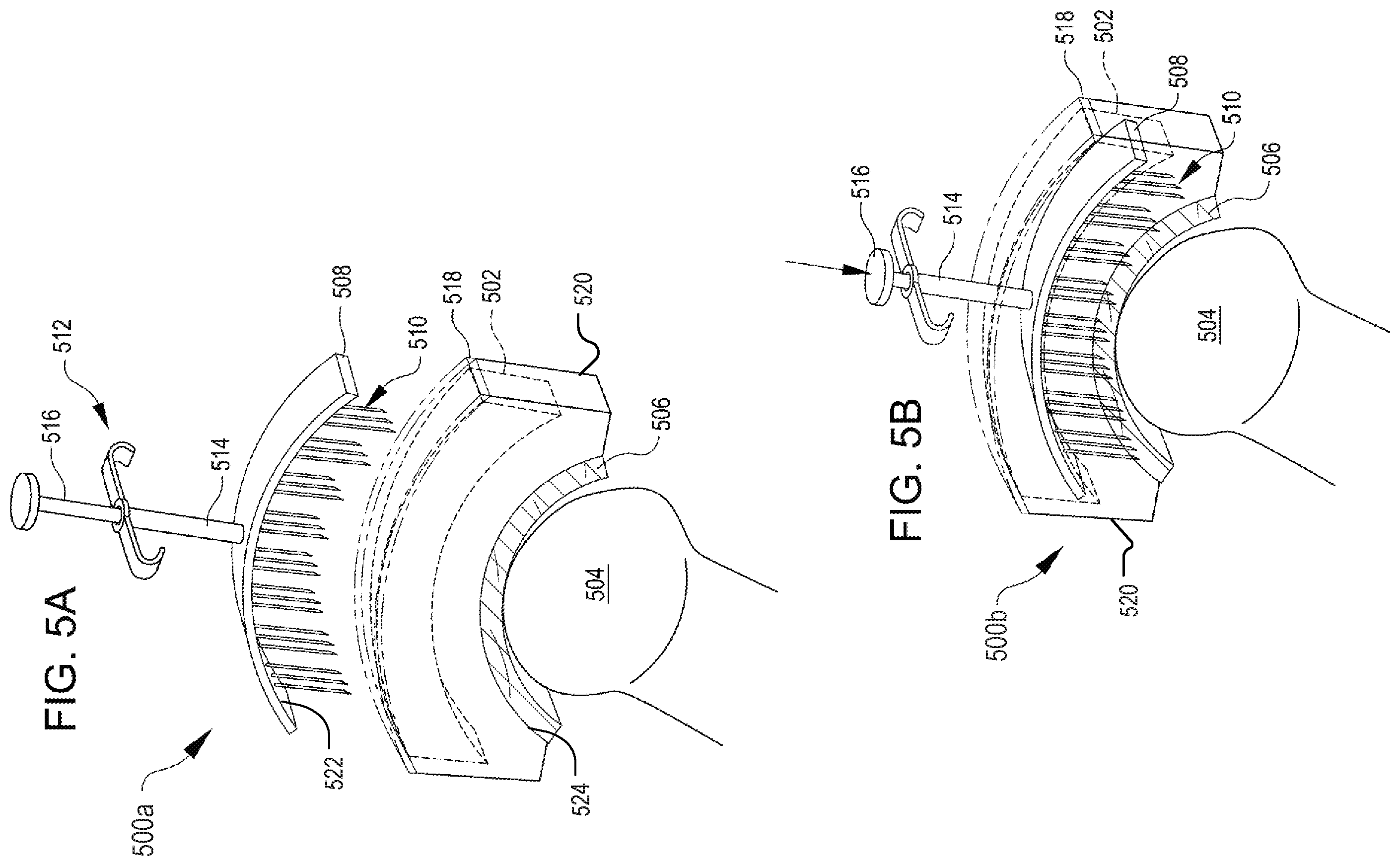 Patent US12508374 Figure 4 – Systems for inhibiting heterotopic ossification