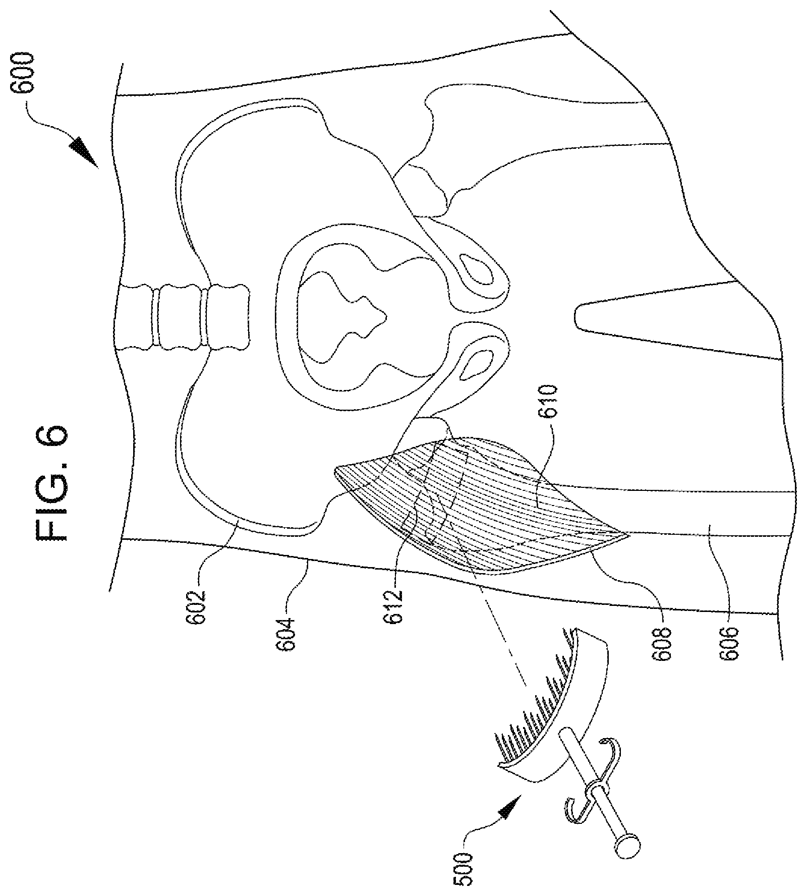 Patent US12508374 Figure 5 – Systems for inhibiting heterotopic ossification