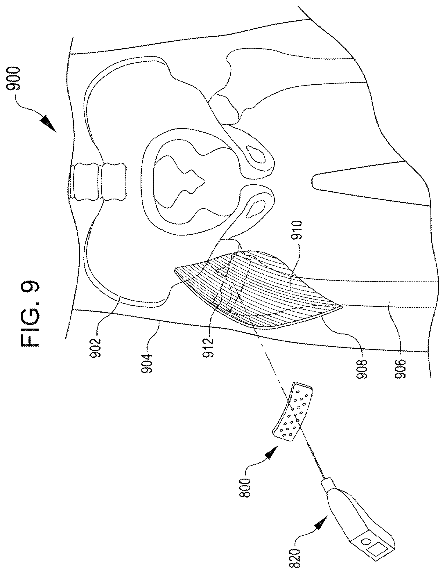Patent US12508374 Figure 8 – Systems for inhibiting heterotopic ossification