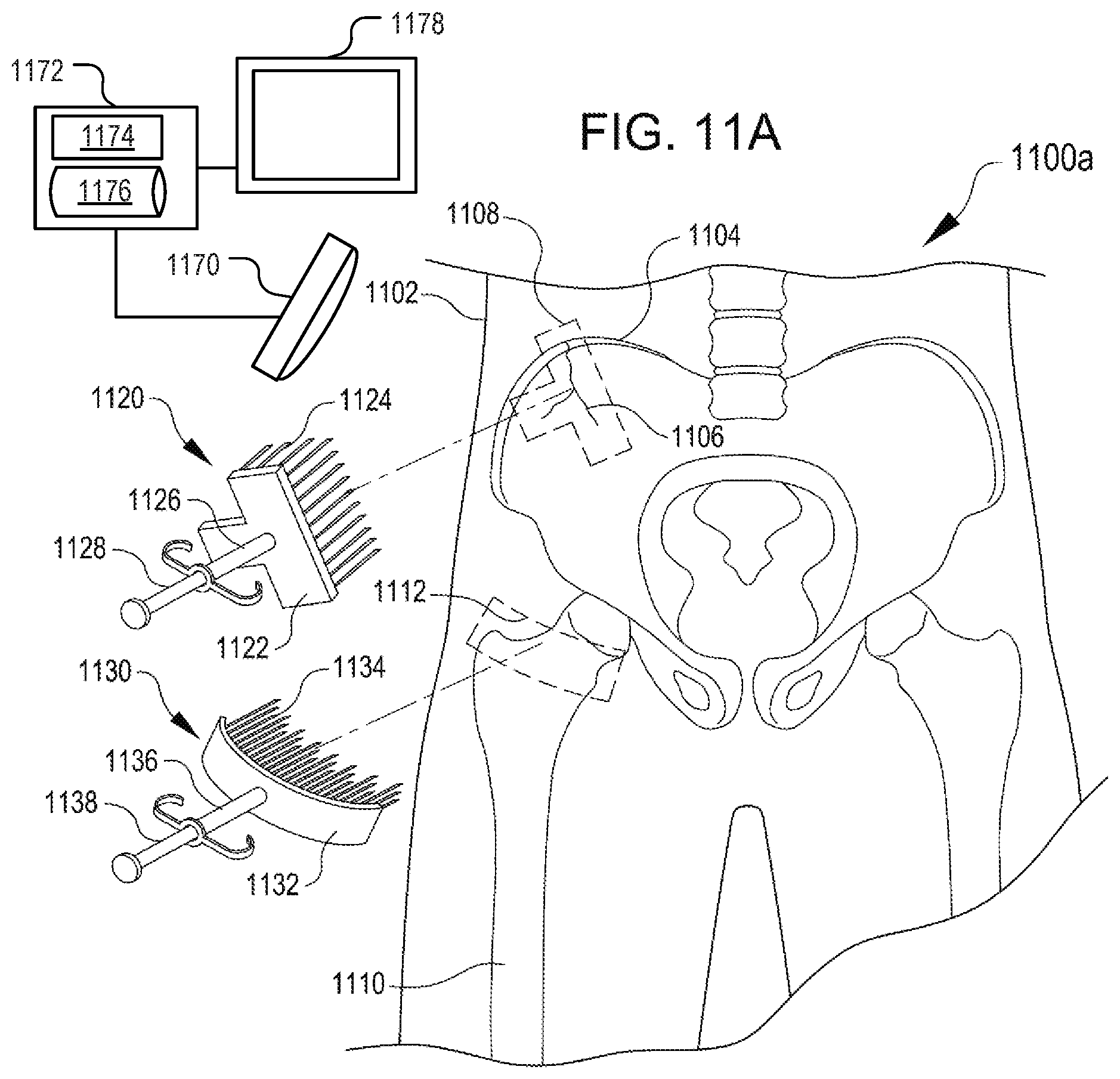 Patent US12508374 Figure 10 – Systems for inhibiting heterotopic ossification