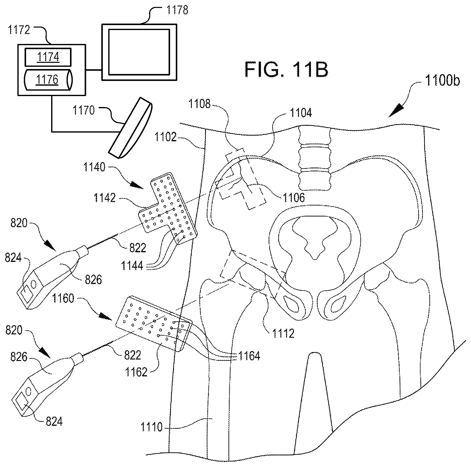 Patent US12508374 Figure 11 – Systems for inhibiting heterotopic ossification