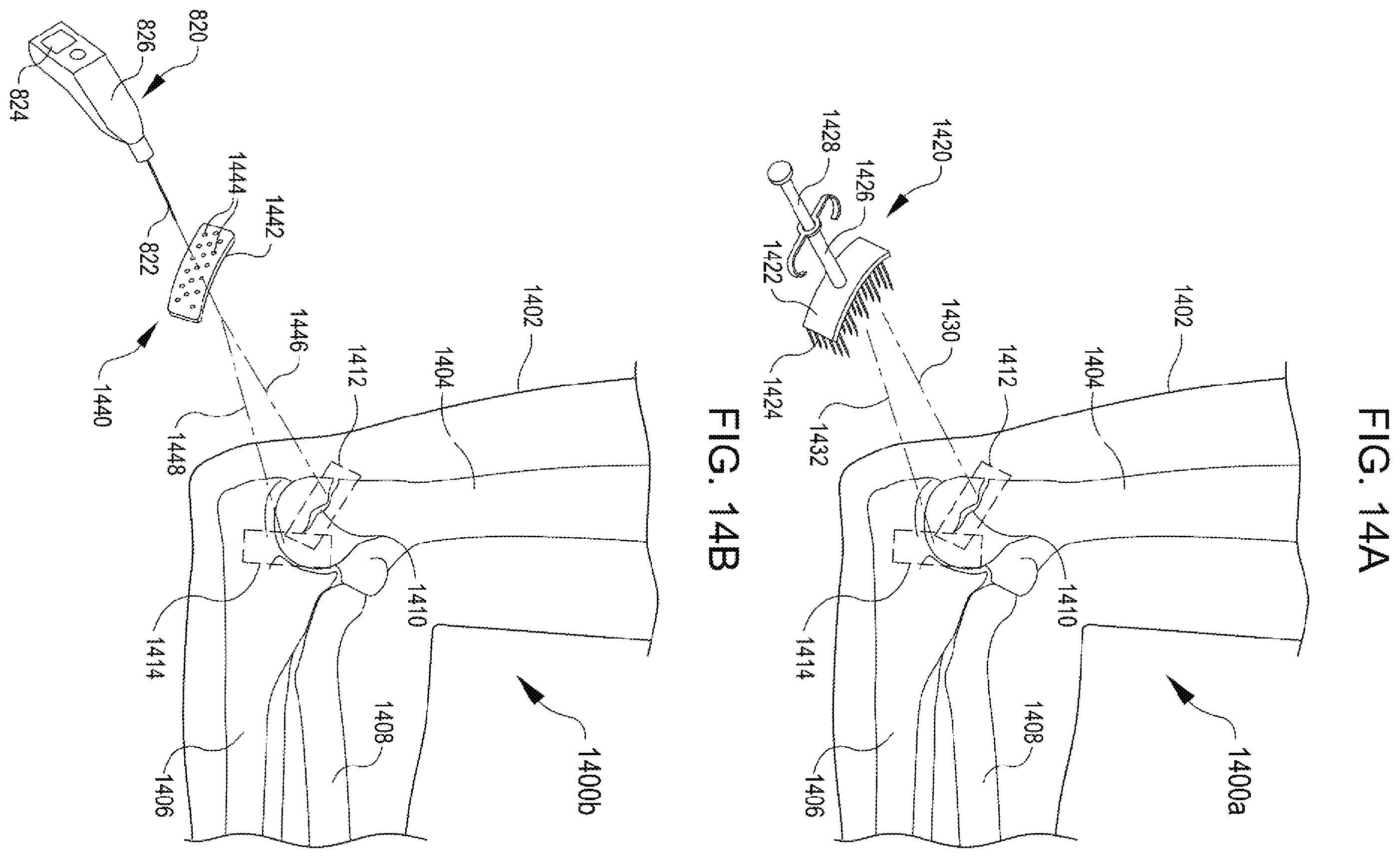 Patent US12508374 Figure 15 – Systems for inhibiting heterotopic ossification