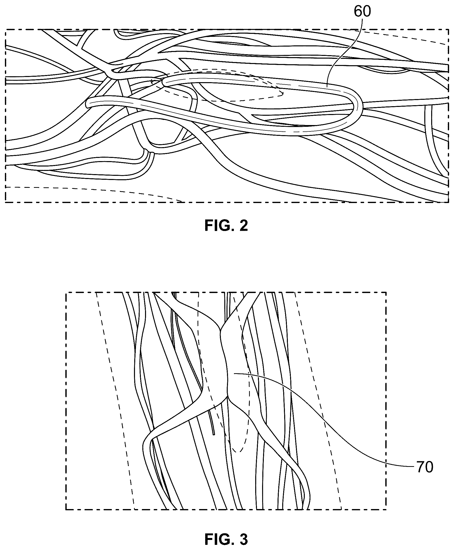 Patent US12508375 Figure 2 – Vascular access device and methods