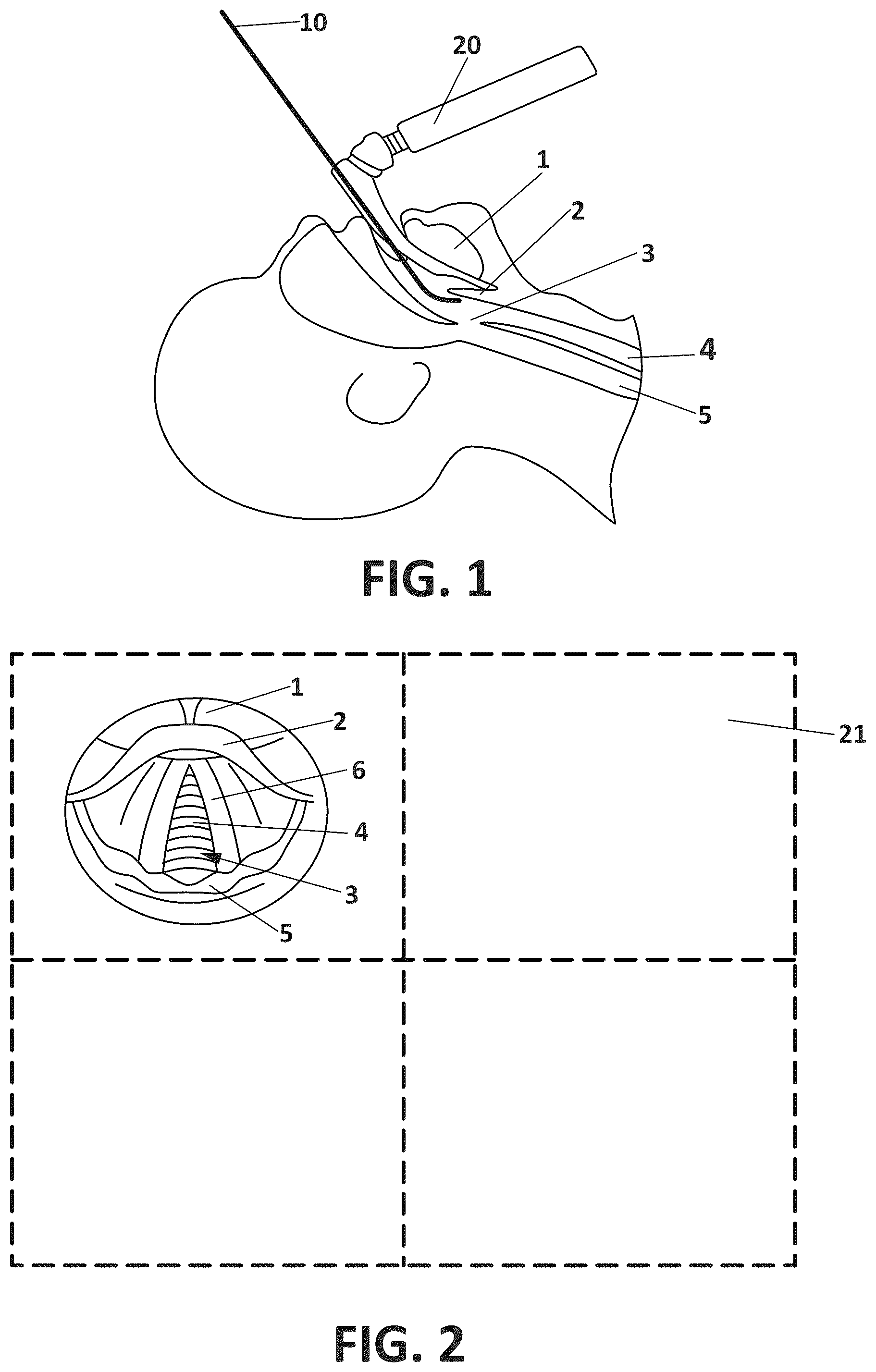 Patent US12508380 — Intubation bougie — Figure 1
