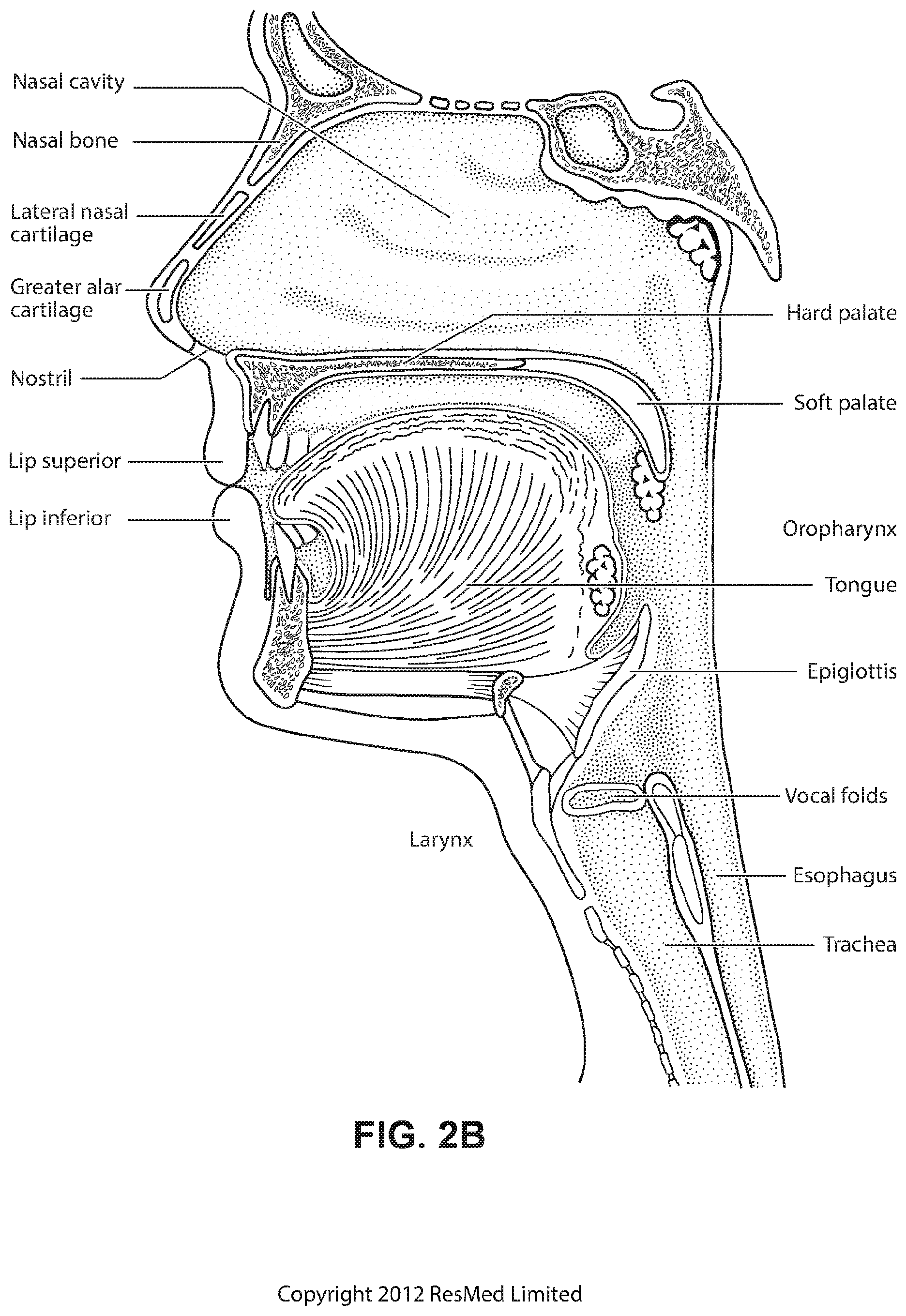 Patent US12508384 Figure 5 – Cushion module for a patient interface