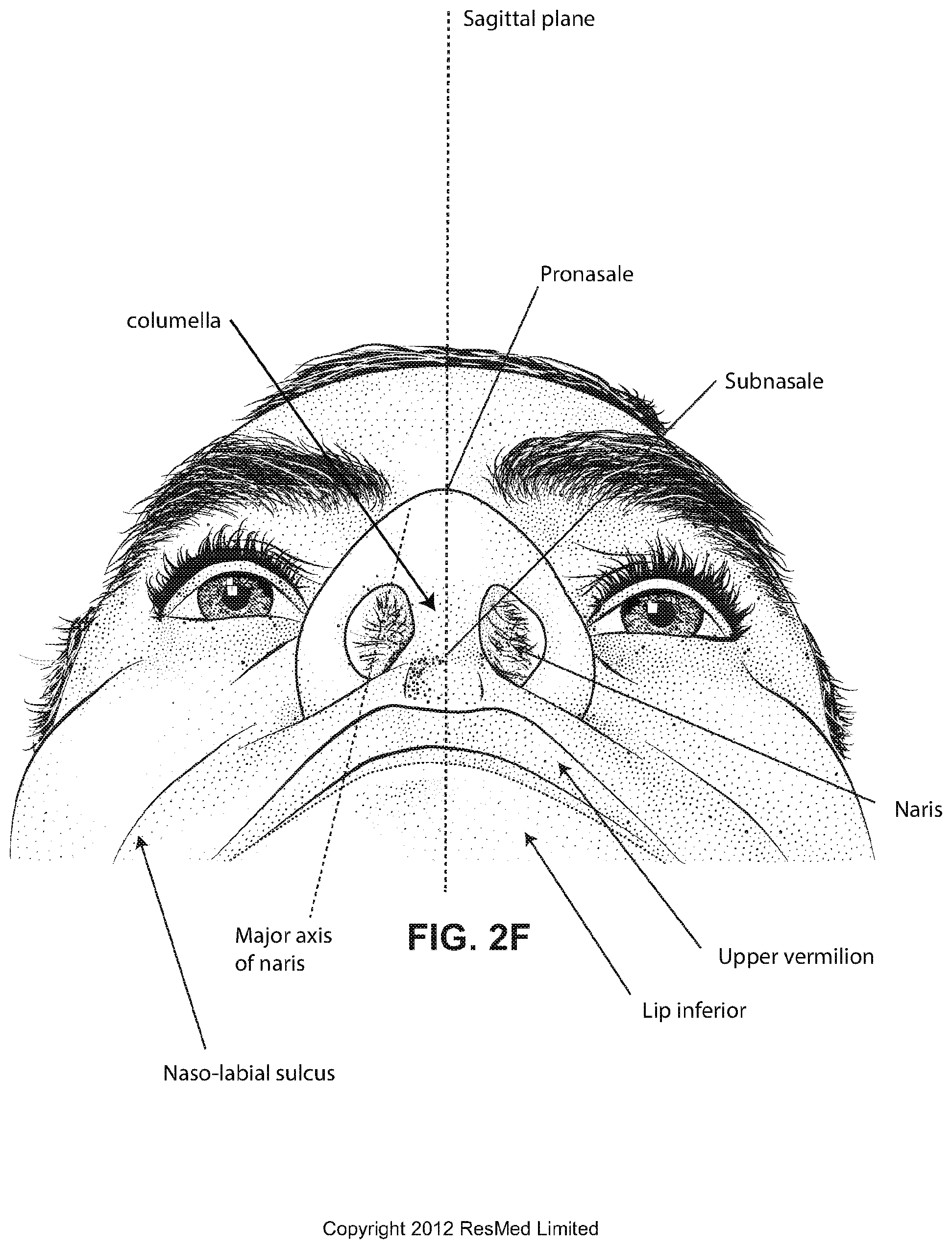 Patent US12508384 Figure 9 – Cushion module for a patient interface