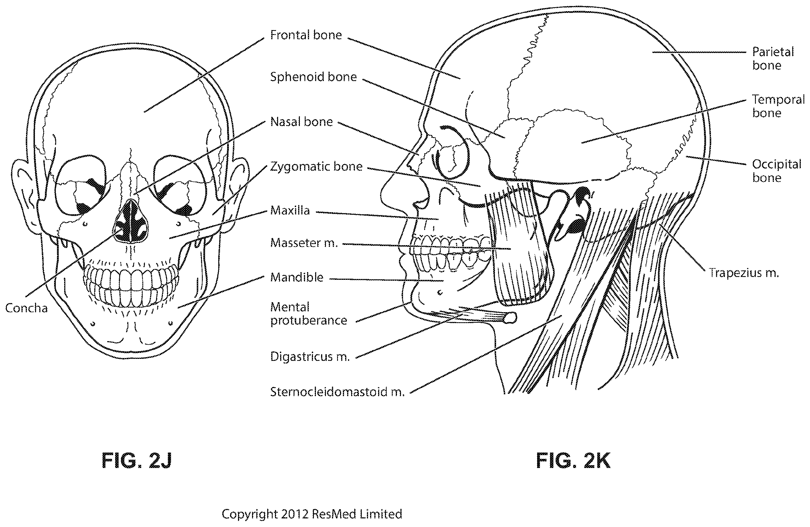 Patent US12508384 Figure 11 – Cushion module for a patient interface